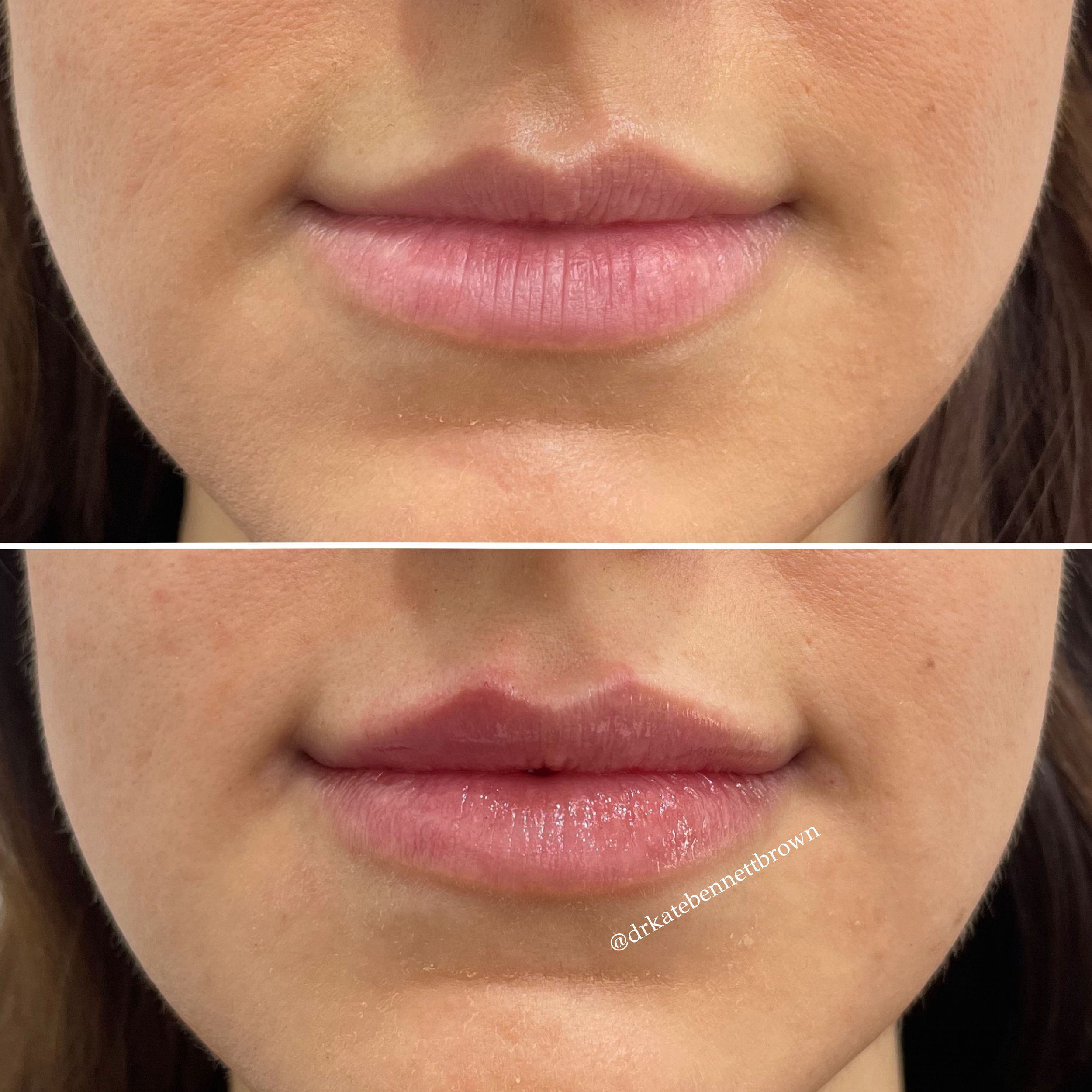 Lip Results
