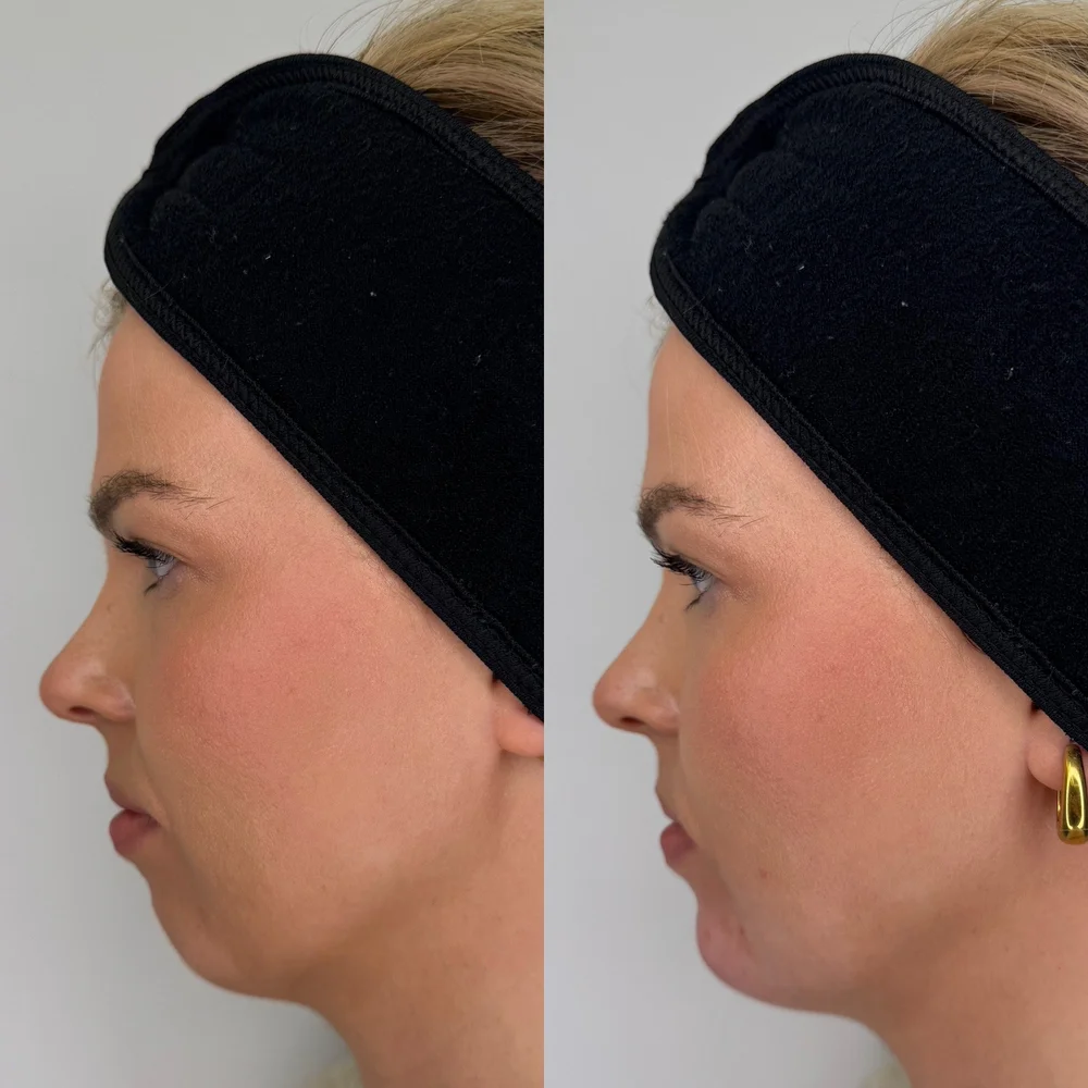 Chin and jawline profile before and after treatment, Dr Kate BB Aesthetics, Battersea London