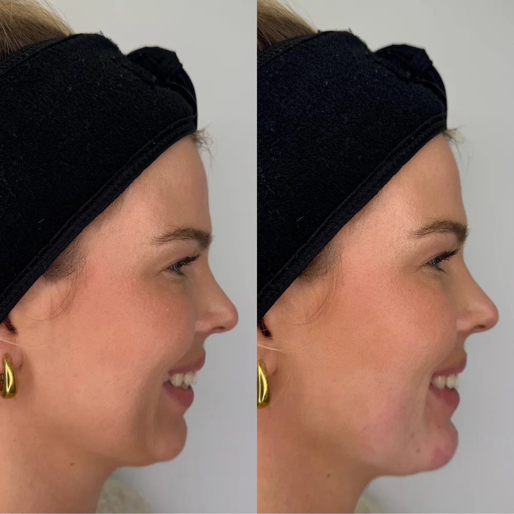 Chin filler before and after, smiling side profile, Dr Kate BB Aesthetics, Battersea London
