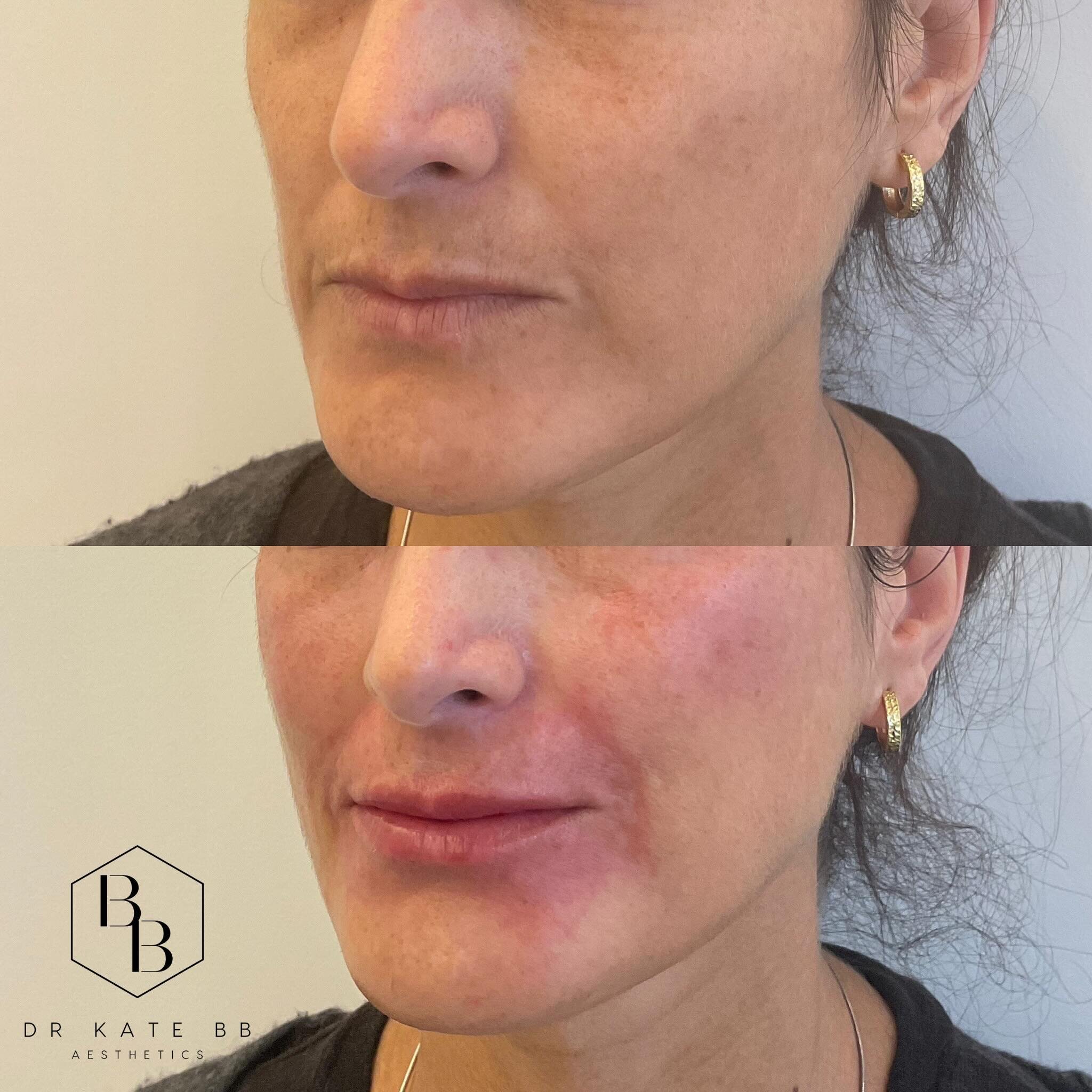 Cheeks, lip and perioral filler for volume replacement and a natural result - always ✨