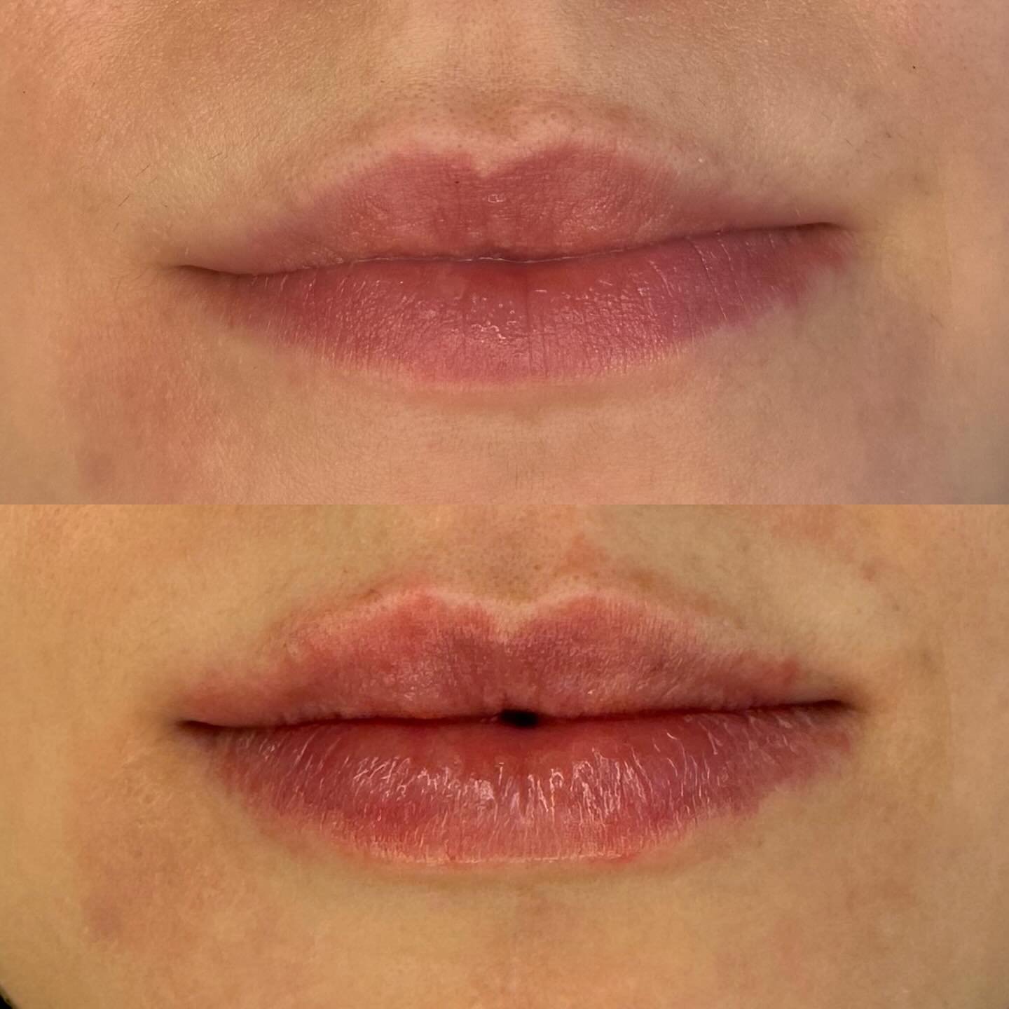 &ldquo;I want some more volume but to keep it really natural&rdquo;

Say no more 💋

Gorgeous gorgeous lips from every angle with a subtle 0.5 ml lip filler for my beautiful patient 💋

Book your lip filler treatment online:

WWW.DRKATEBB.COM
Email: 