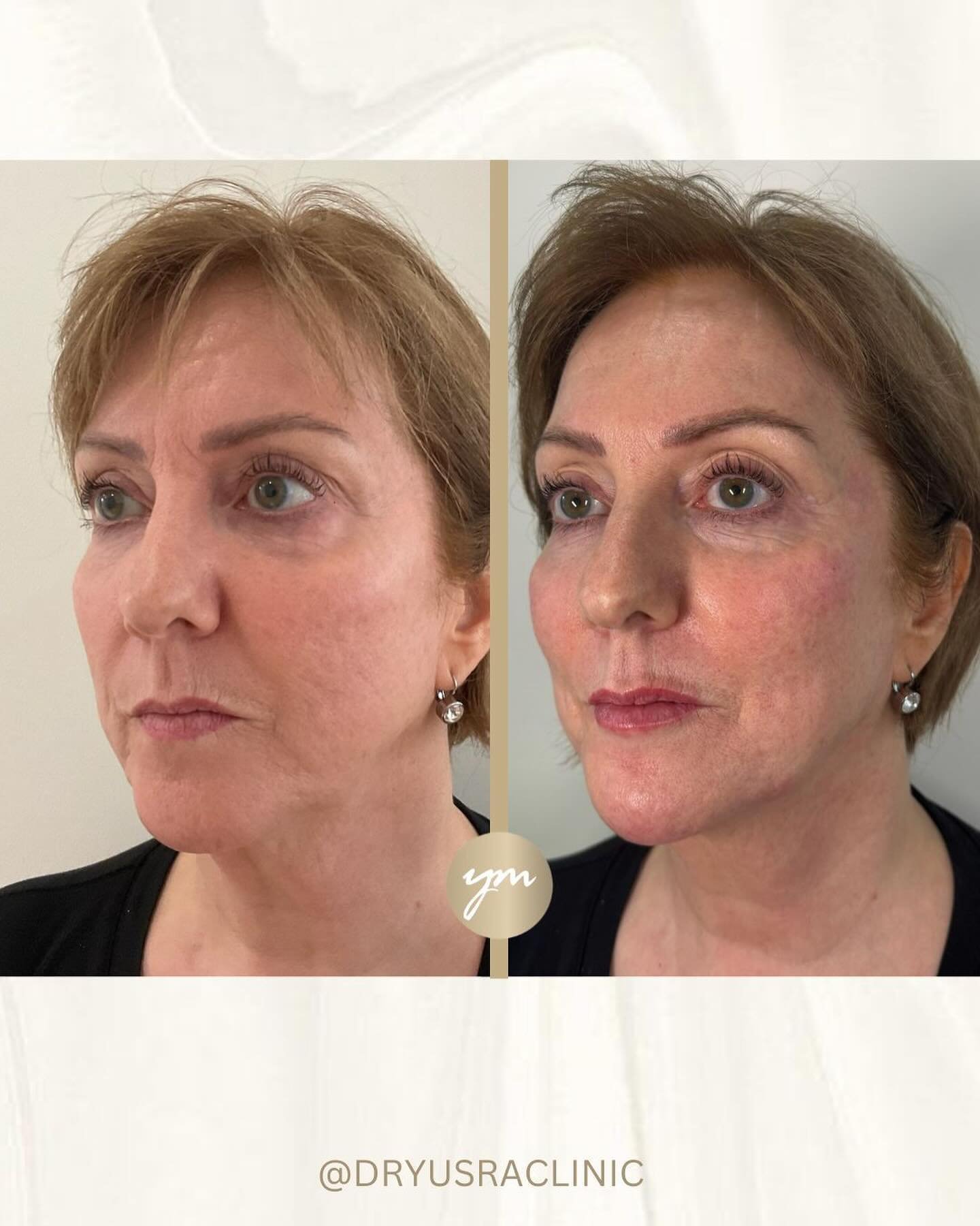 A natural and subtle refresh for our beautiful patient with cheek, nasolabial, chin and lip filler 🫶🏻