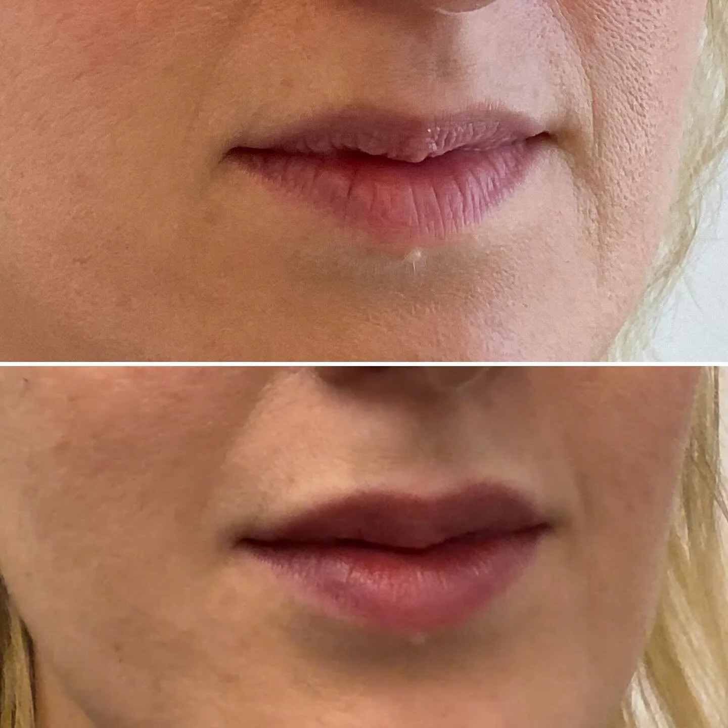 ✨ Subtle, Natural, Beautiful Lips ✨
In this transformation, we focused solely on enhancing the upper lip to improve volume and symmetry while maintaining a natural, balanced result.
The after photo was taken a few months post-treatment, once the sw