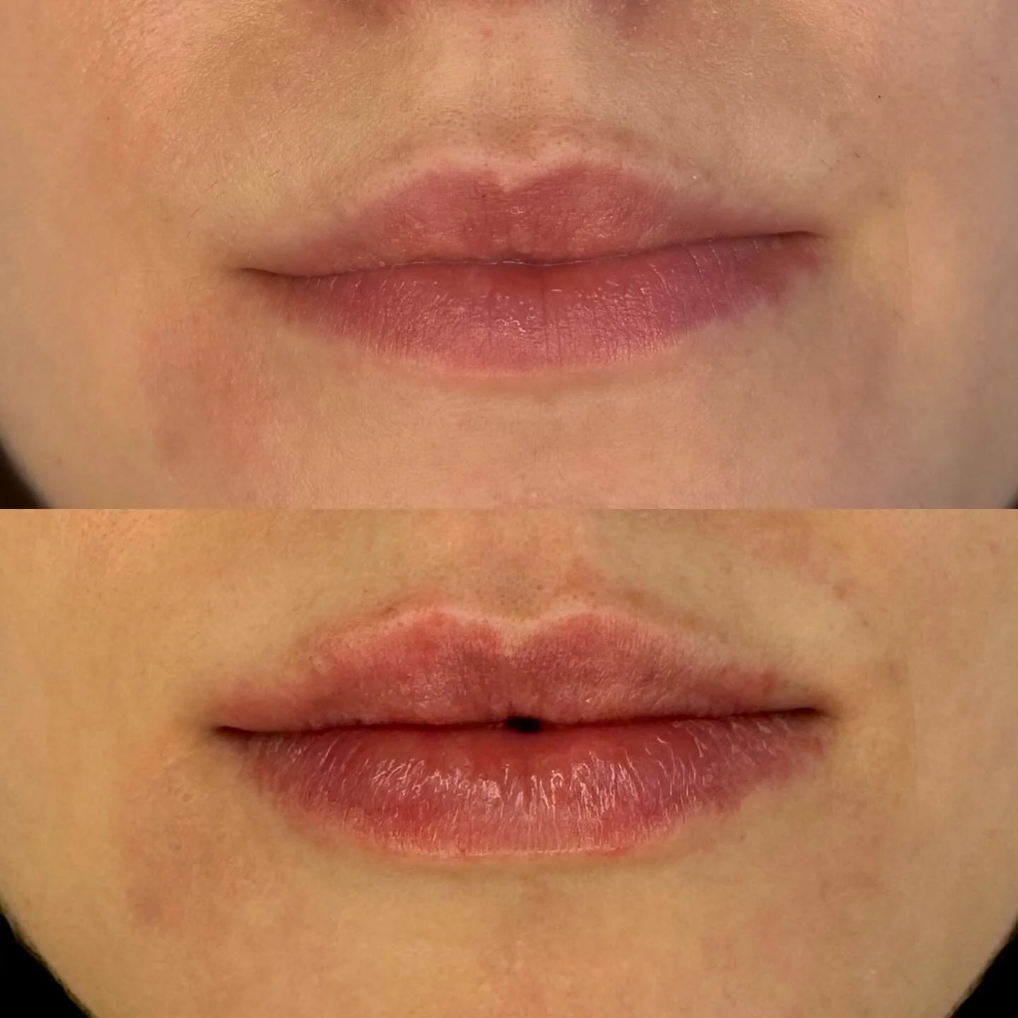 The most natural lip filler results ✨
Subtle definition, lifted borders, your lips - just refreshed. 
This result was achieved with 0.4 ml lip filler.

Appointments available 
📩DM 
📧 contact@drkatebb.com
🌐 www.drkatebb.com