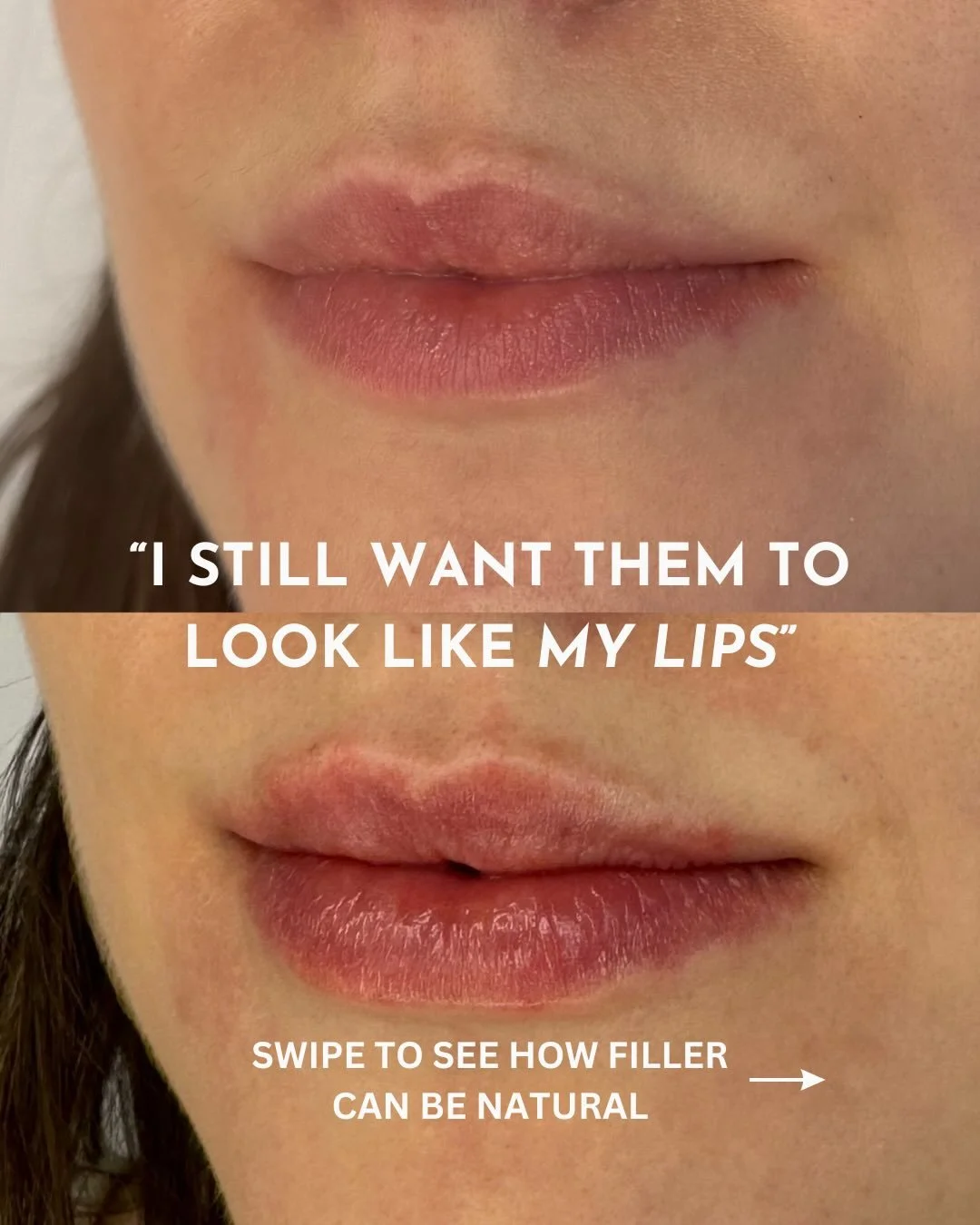 &ldquo;I still want them to look like my lips.&rdquo;

This is something I hear often in clinic &mdash; and it&rsquo;s exactly how I approach lip treatment.

The goal is never to change your face or give you someone else&rsquo;s lips. It&rsquo;s to r
