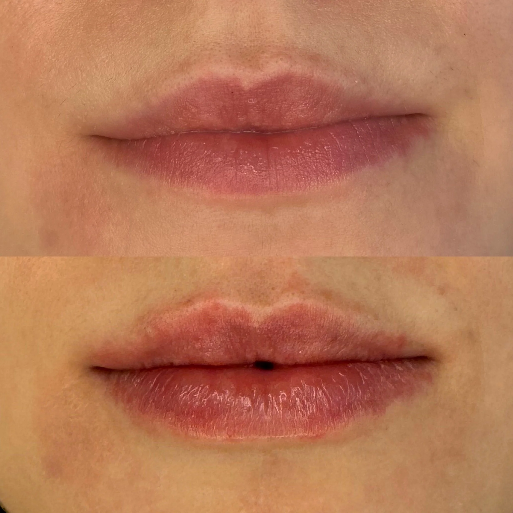 I Didn’t Get Lip Filler to Change My Face — I Got It to Feel Like Myself