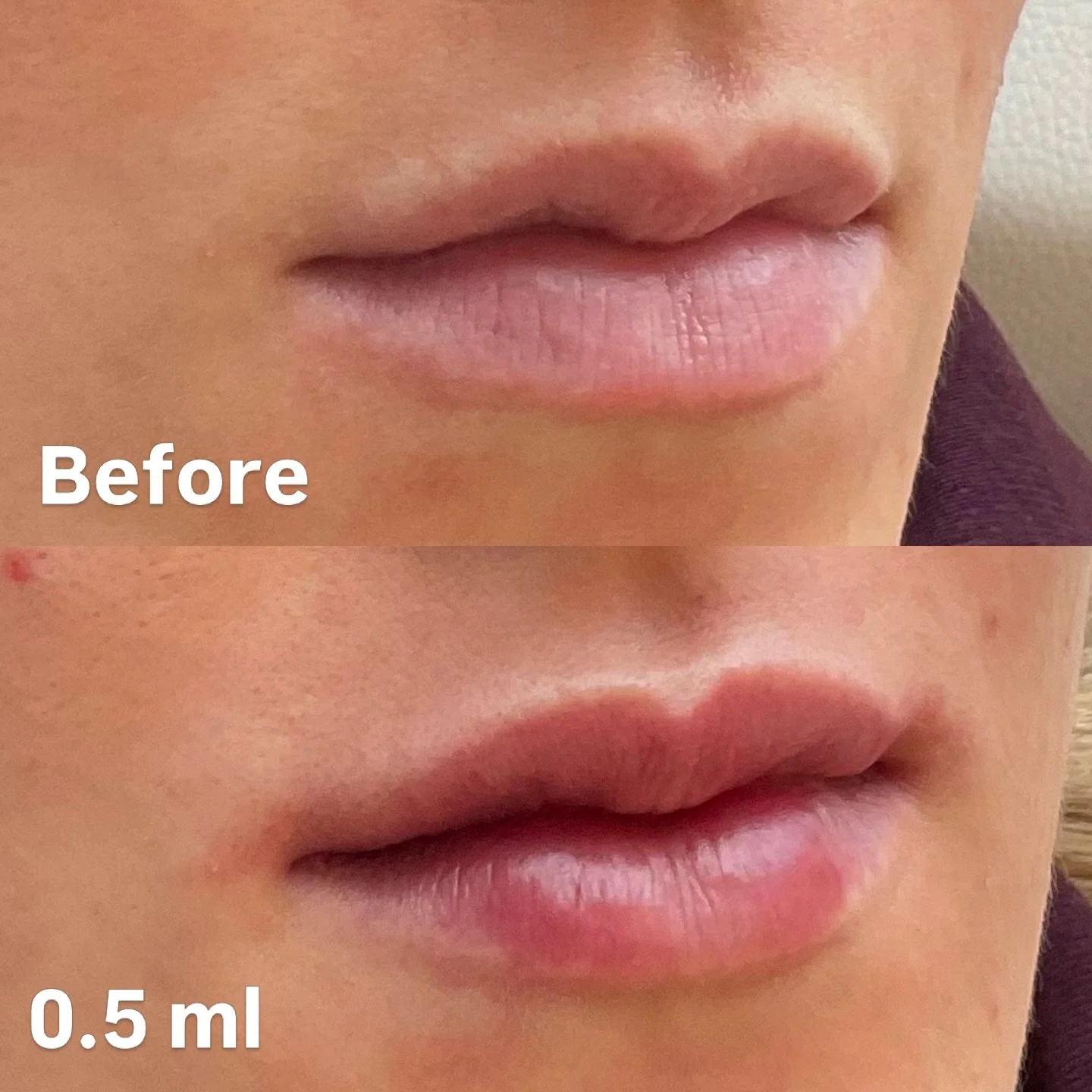 Before and after 0.5 ml Lip Filler

Natural shape. Natural smile. Always.

Dr Kate