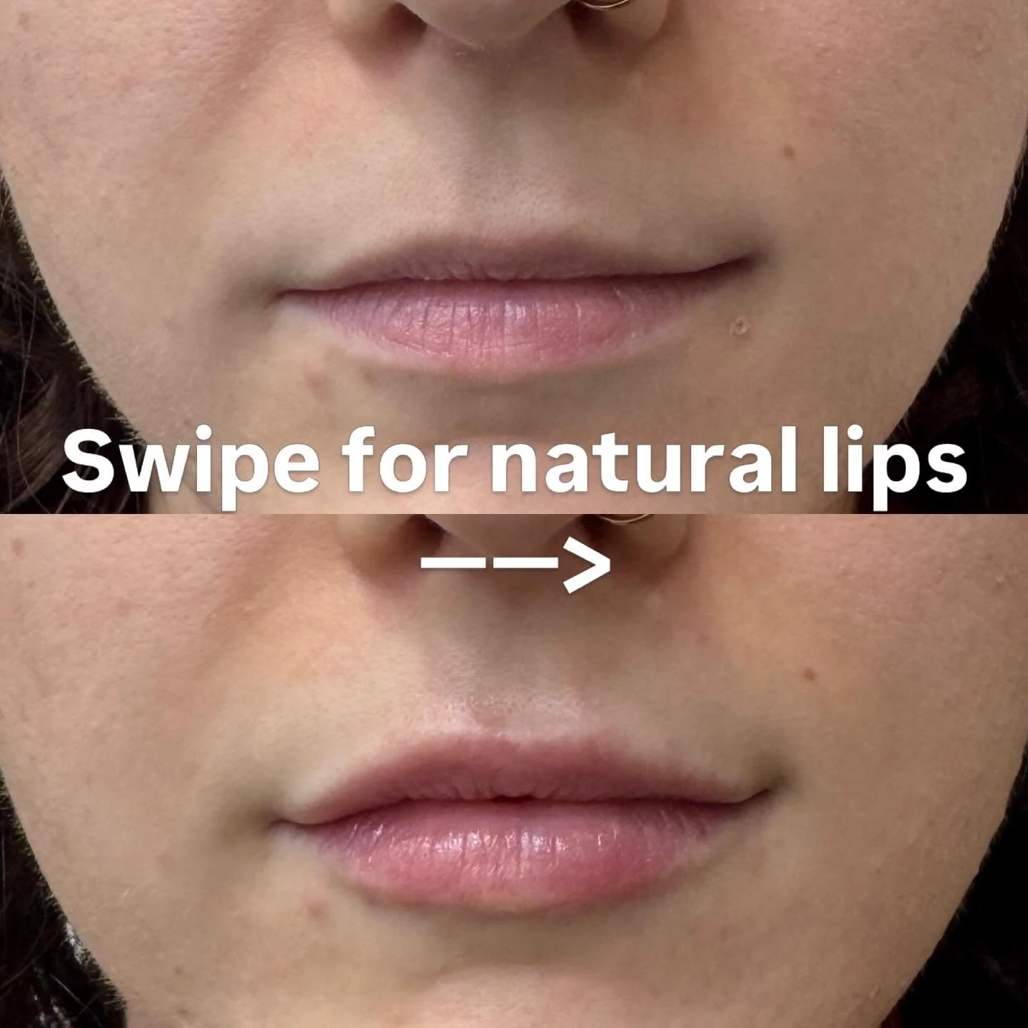 Natural lip filler for some subtle volume but in a completely natural way so no one can tell you have it. This is achieved by assessment and treatment planning both at rest and on dynamic movement 🫶🏻