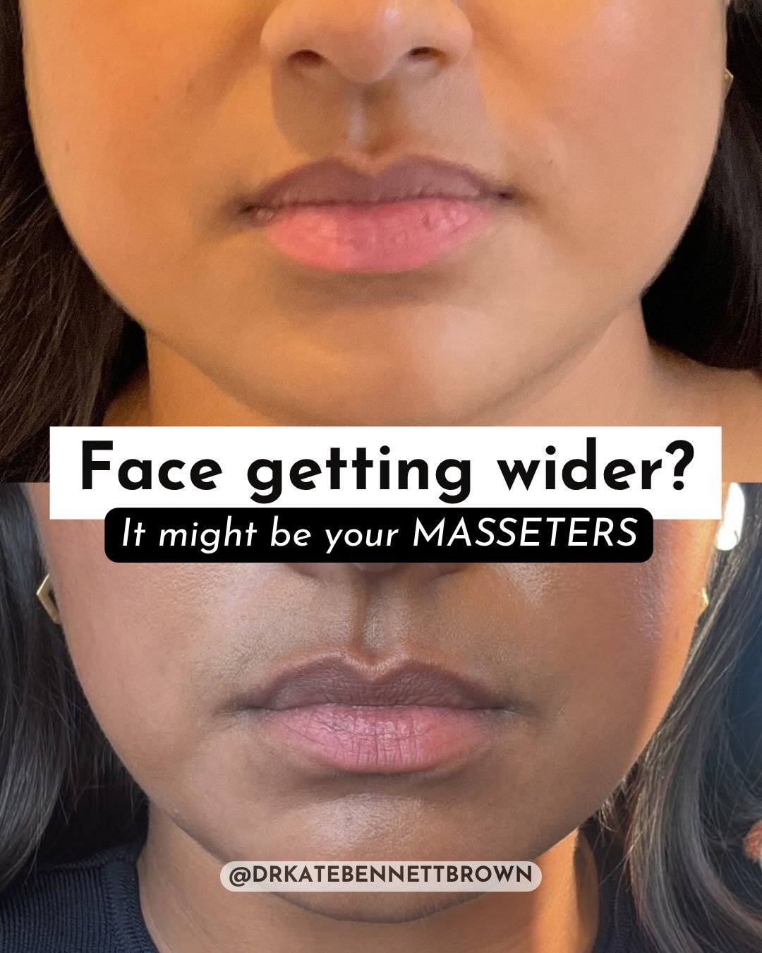 Why is my face getting wider?

Sometimes, the answer is muscle.

The masseters are powerful muscles at the sides of the jaw. If they become enlarged &mdash; often through clenching or grinding &mdash; they can create a wider, squarer appearance throu