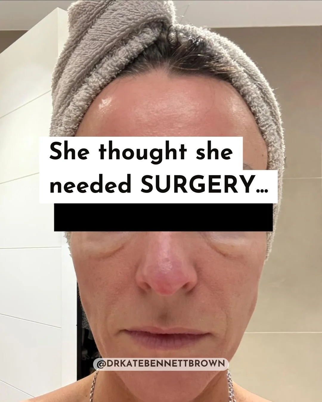 She thought she needed surgery.

This patient came to see me concerned about persistent puffiness under her eyes. She felt she looked tired and swollen, particularly in the mornings, and had already arranged a surgical consultation to discuss lower e