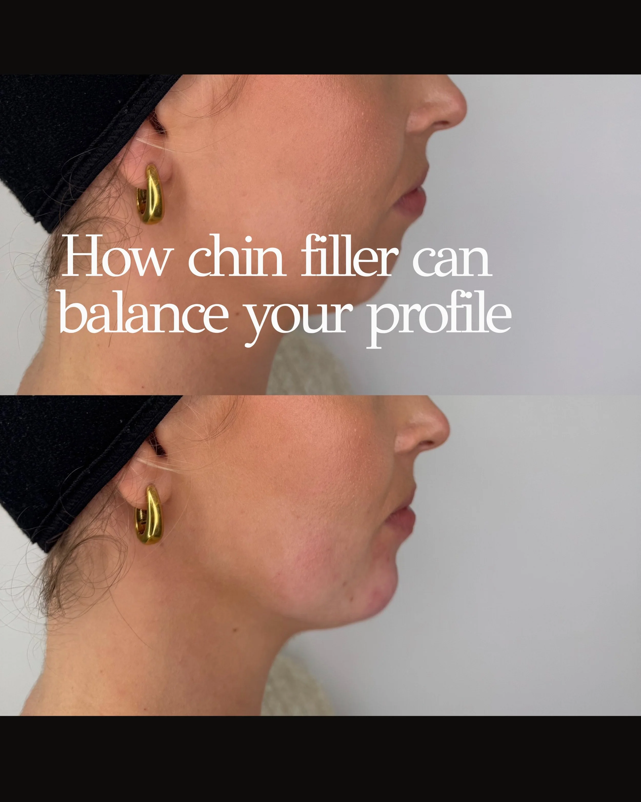 Chin filler isn&rsquo;t about making the chin look bigger - it&rsquo;s about bringing the whole profile into better balance.

When the chin sits slightly further back, it can make the jawline look shorter and the area under the chin appear heavier. A