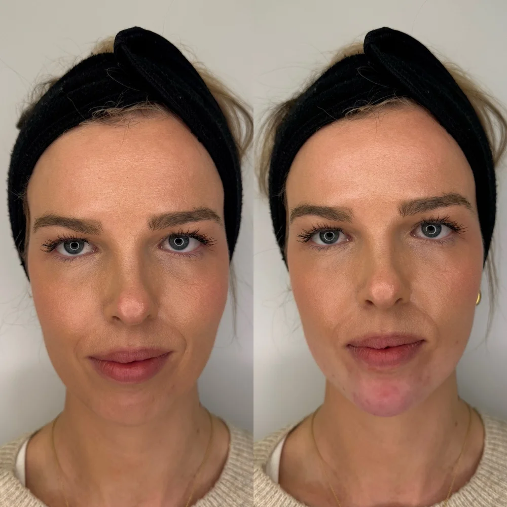 Chin filler before and after, front view, Dr Kate BB Aesthetics, Battersea London