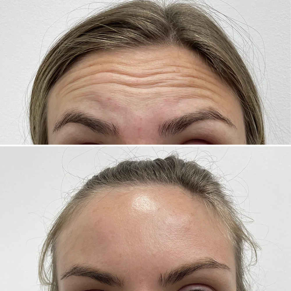 Forehead and frown lines before and after treatment, Dr Kate BB Aesthetics, Battersea London