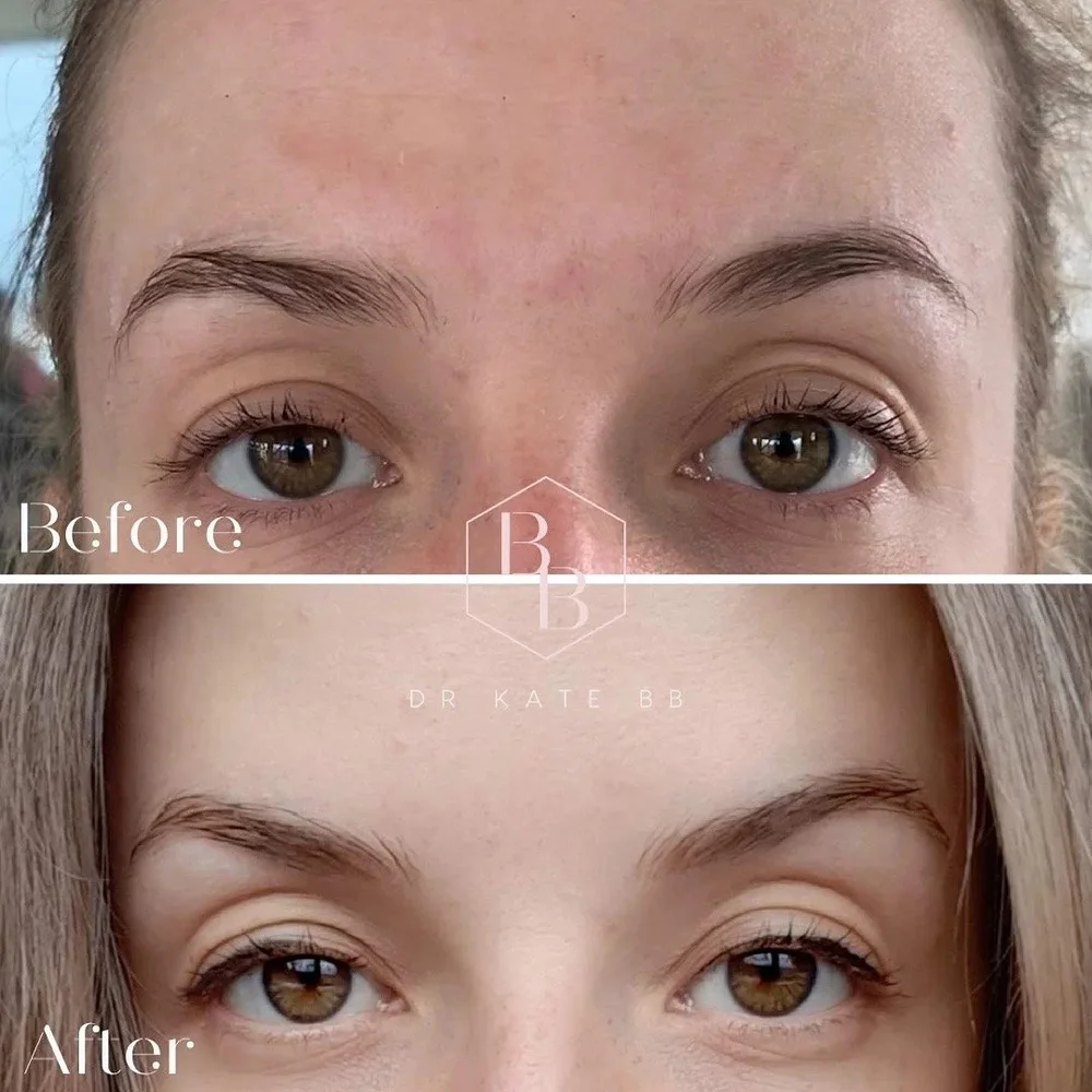 Eye area before and after treatment, Dr Kate BB Aesthetics, Battersea London