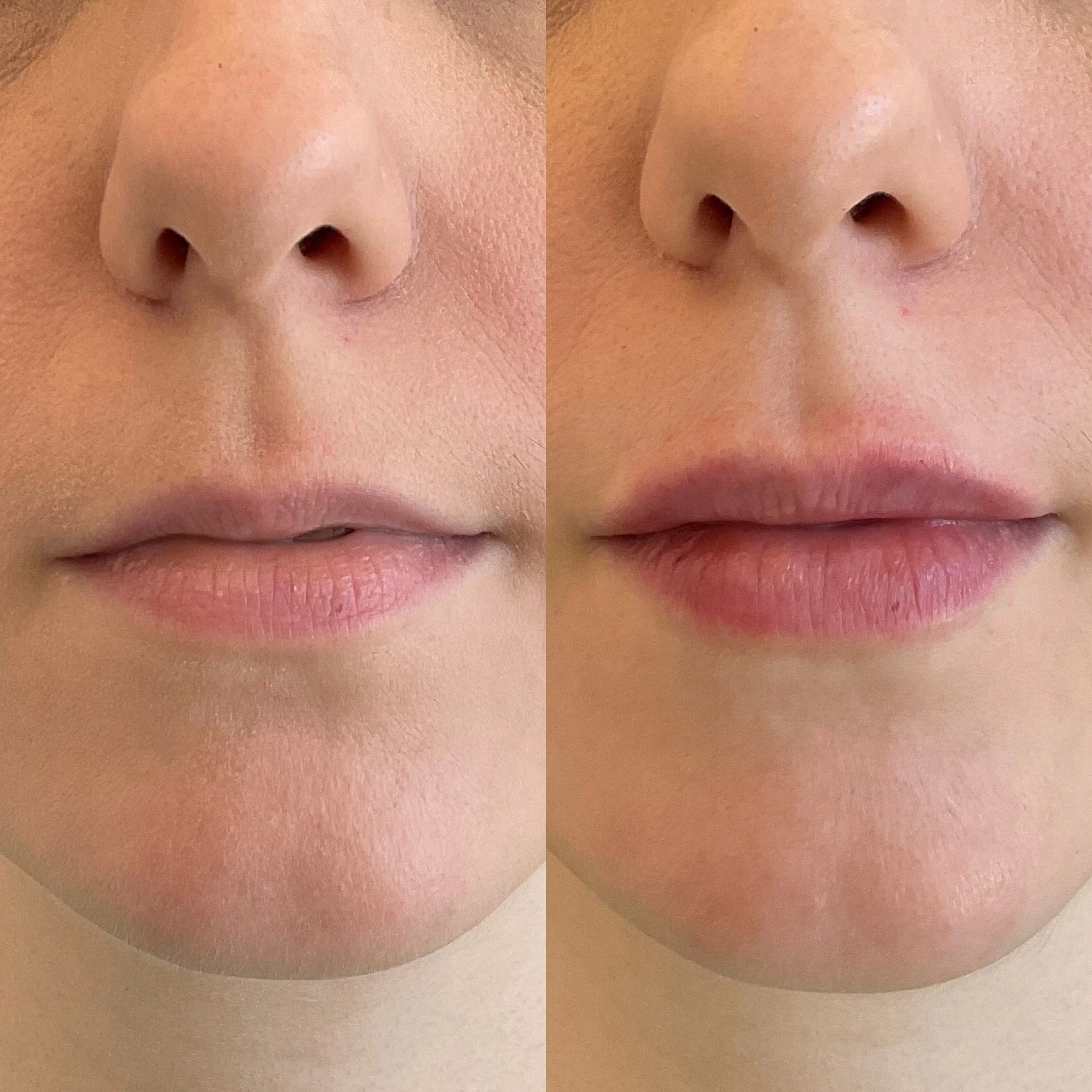 Lip Results