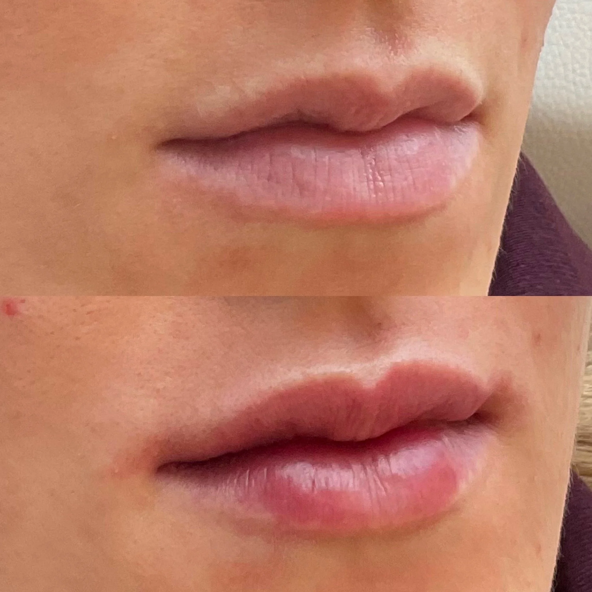Lip Results