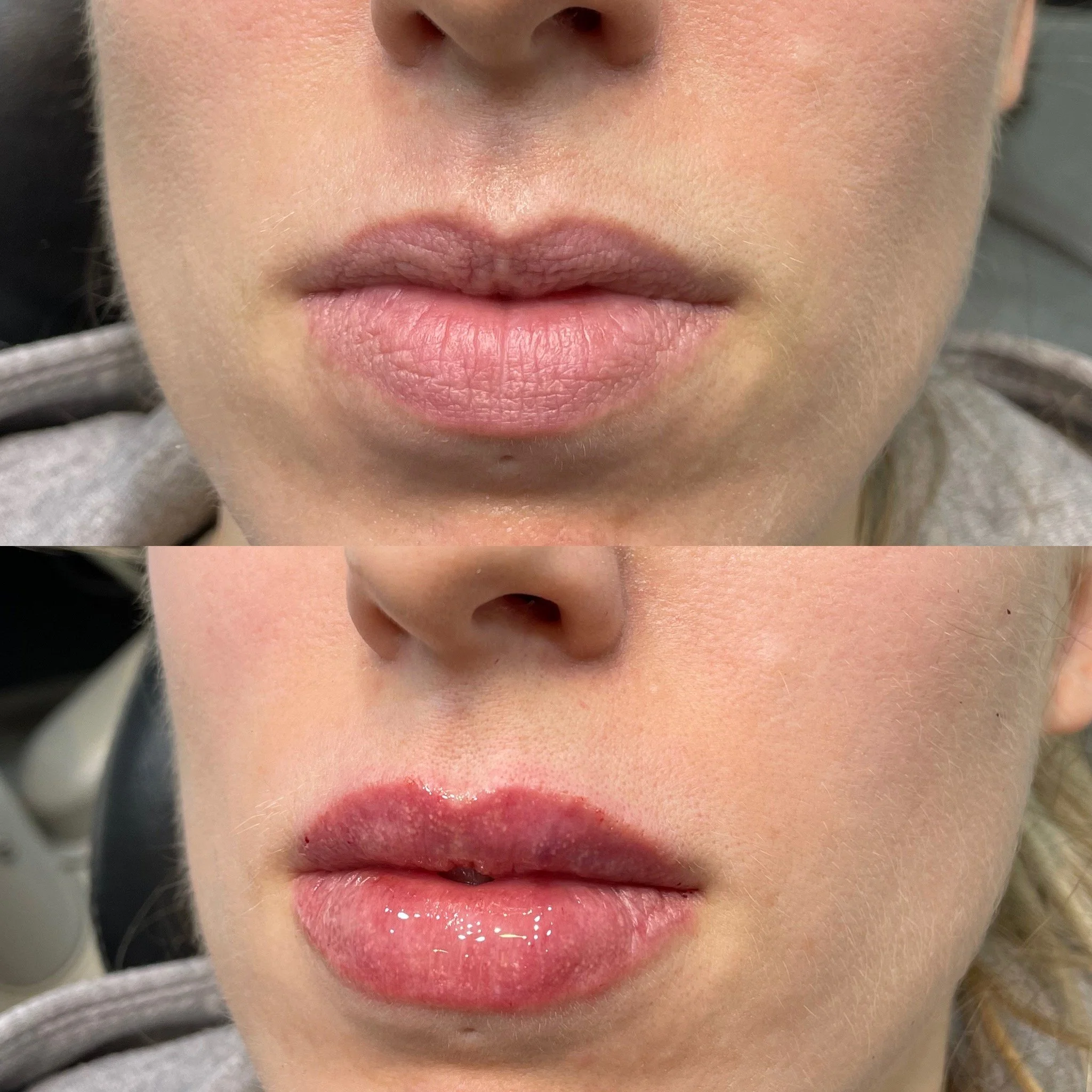 Lip Results
