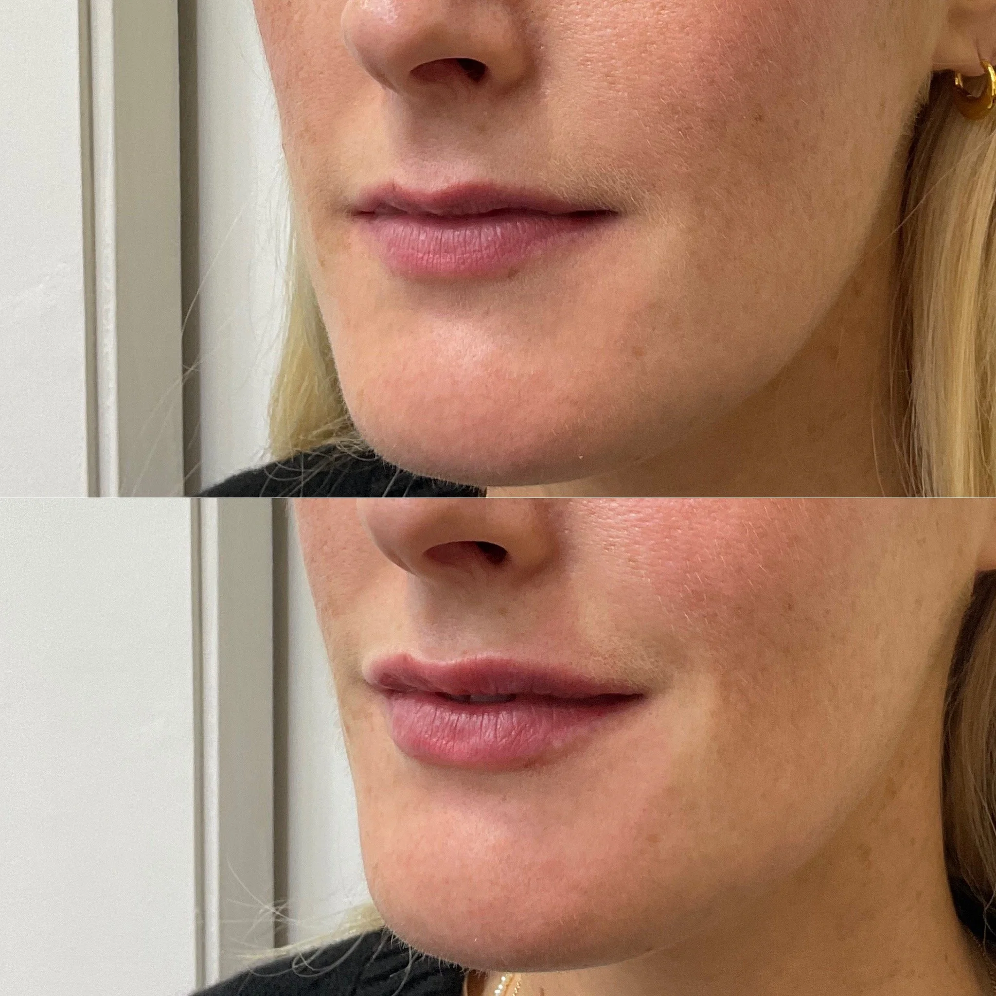Lip Results