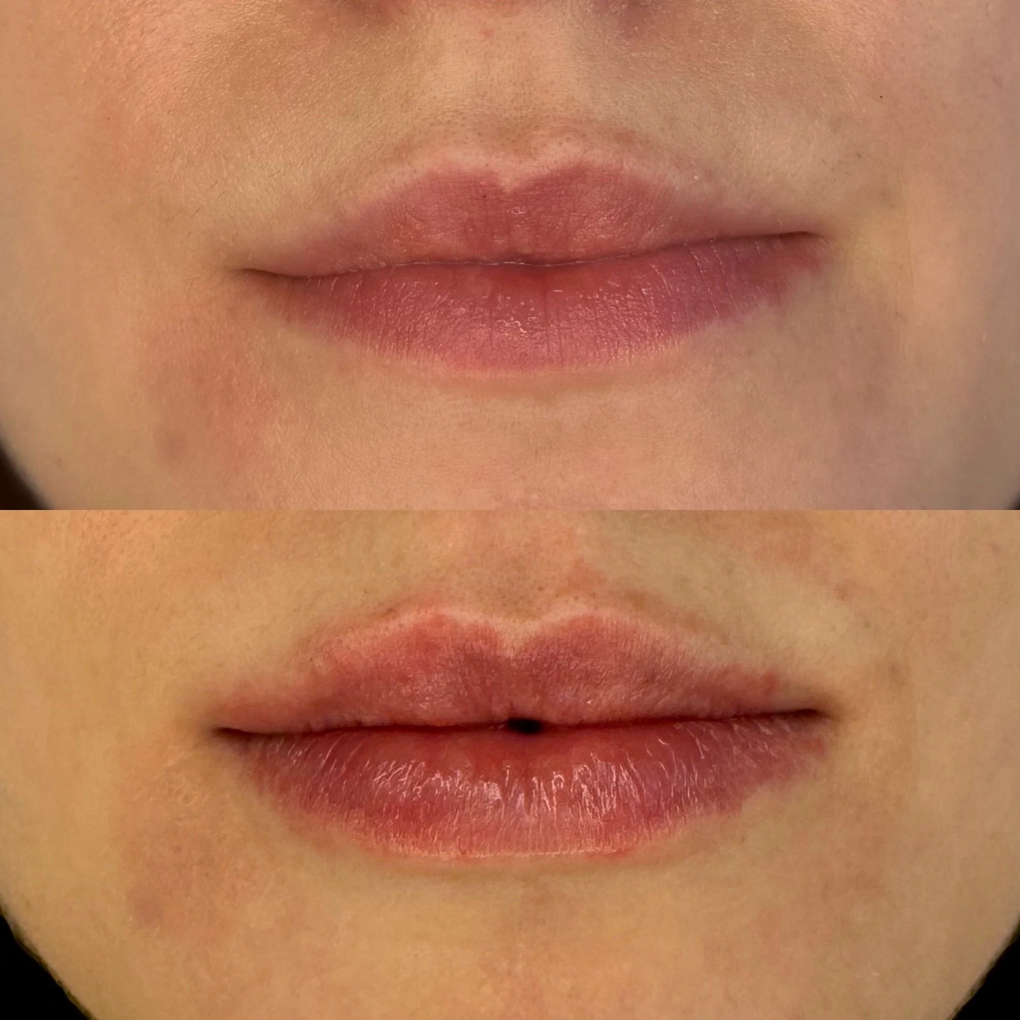 Lip Results