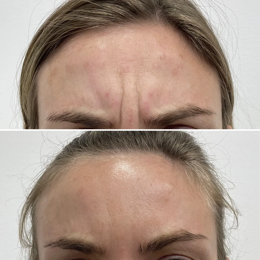 Forehead lines before and after treatment, Dr Kate BB Aesthetics, Battersea London