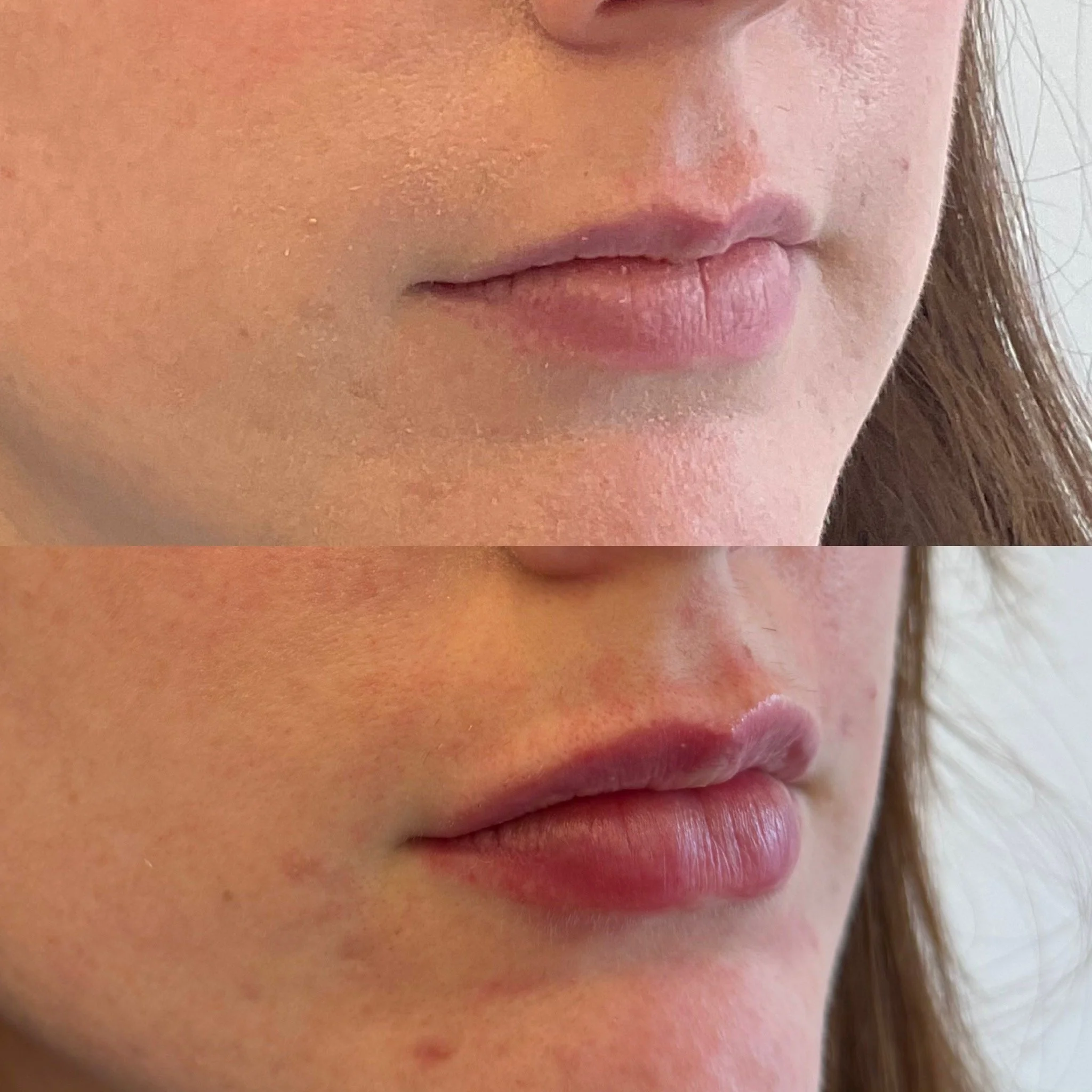 Lip Results