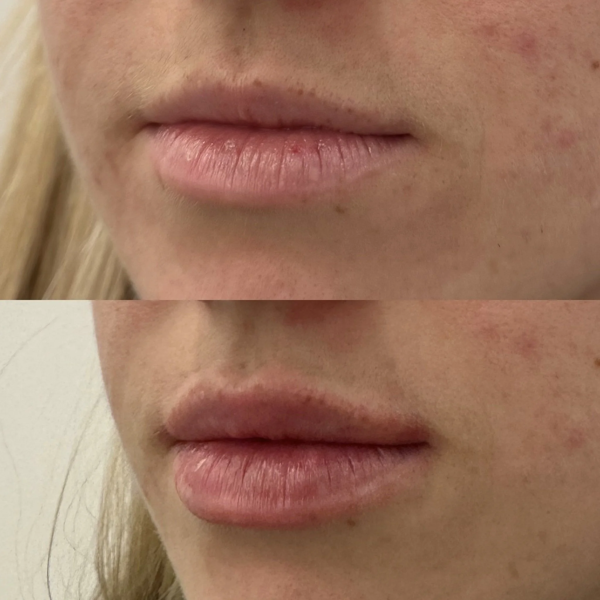 Lip Results