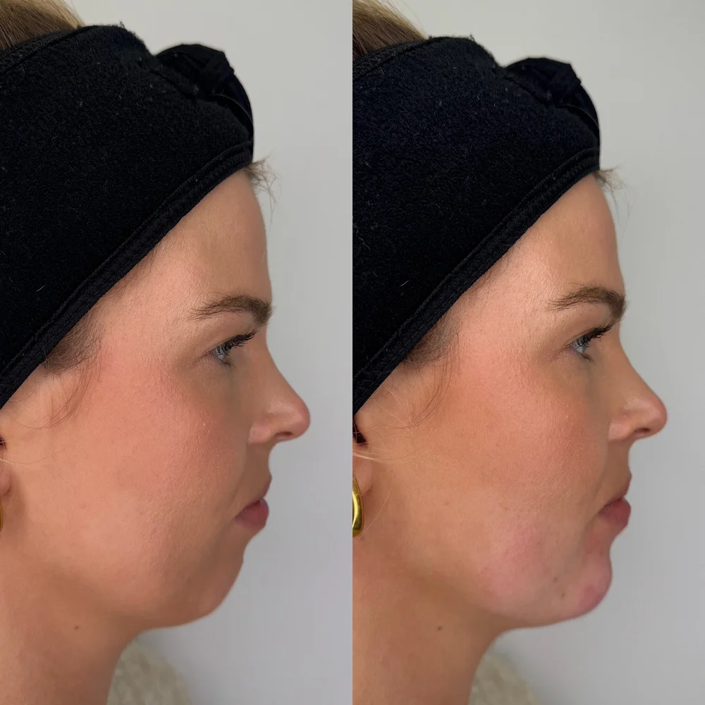 Chin filler before and after, side profile, Dr Kate BB Aesthetics, Battersea London