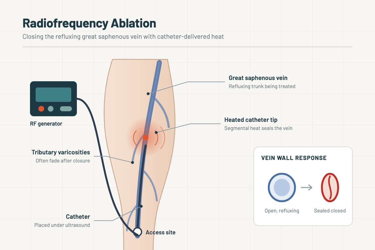 radiofrequency ablation procedure diagram