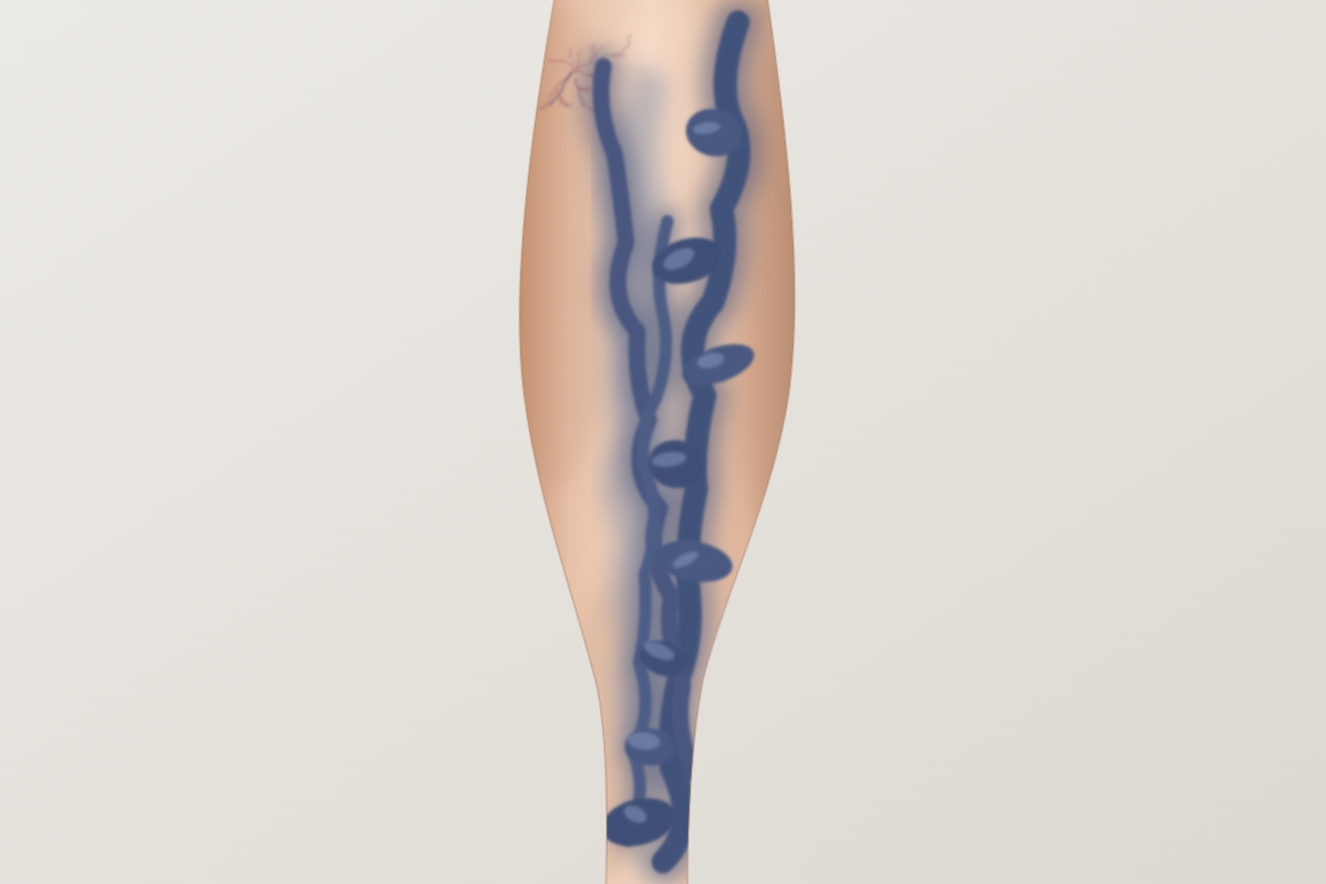 varicose veins on leg before treatment