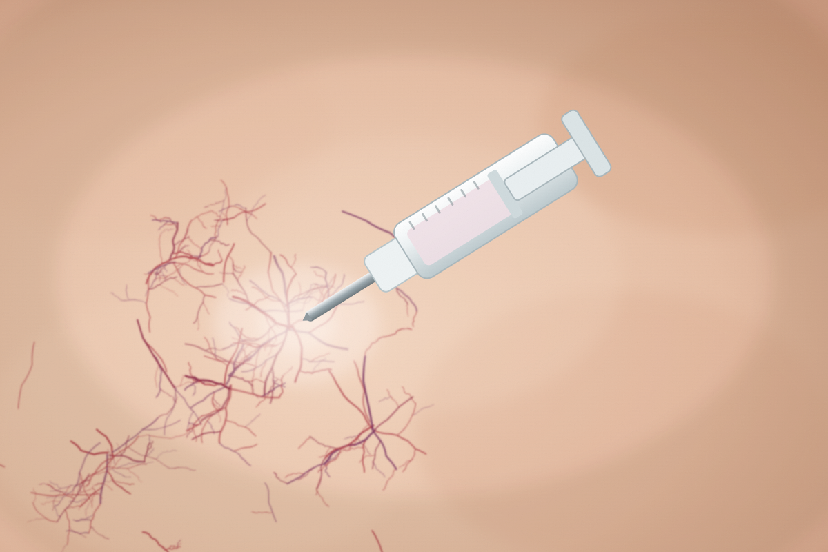 sclerotherapy treatment for spider veins Newport Beach