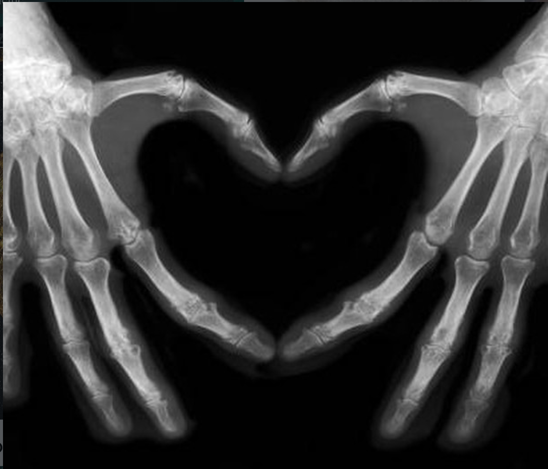 X-ray image showing skeletal hands forming a heart shape with the face of a person visible in the center.