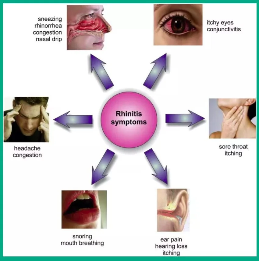 Rinitis alergi adalah kondisi inflamasi pada mukosa hidung yang dipicu ...