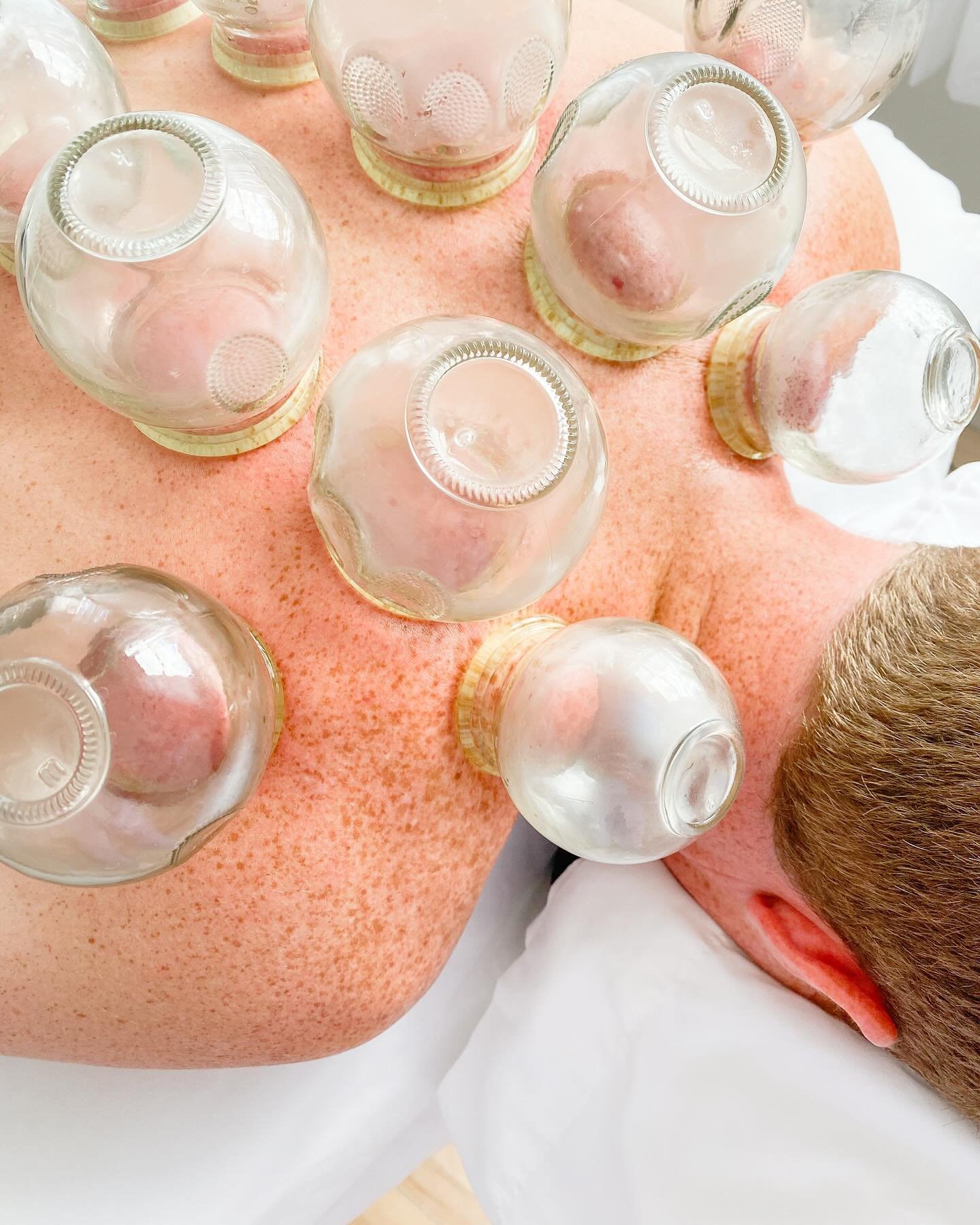 Can acupuncture and cupping give you more energy?

🌿Acupuncture and cupping therapy can both potentially boost energy levels through different mechanisms. 

🌿Acupuncture targets specific points along the body&rsquo;s meridians to balance Qi flow, p