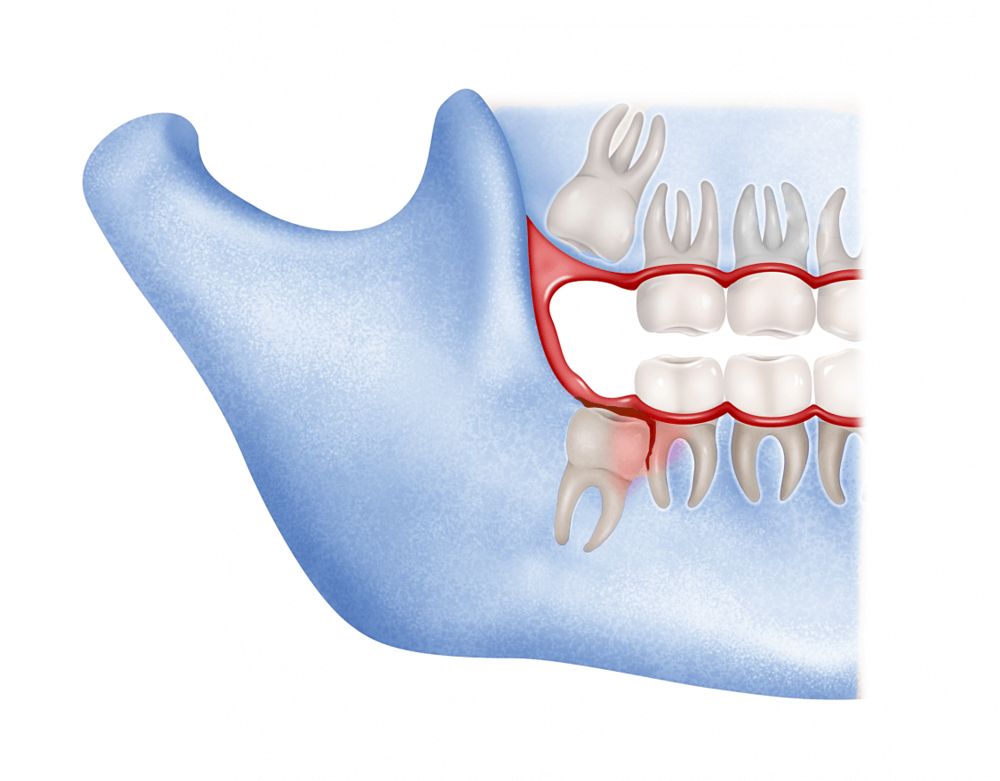 Muelas Del Juicio Cl nica Dental Okendo11 Muelas Del Juicio Cl nica Dental Okendo11