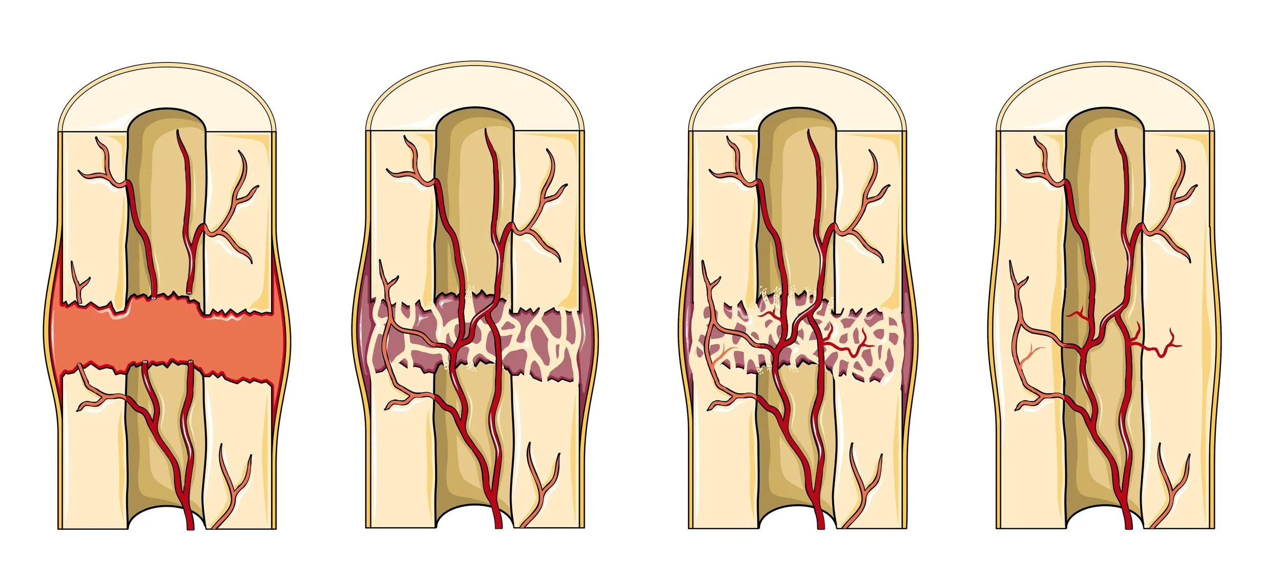 Patient Info / Fracture - Healing and Management — Dr Keran Sundaraj