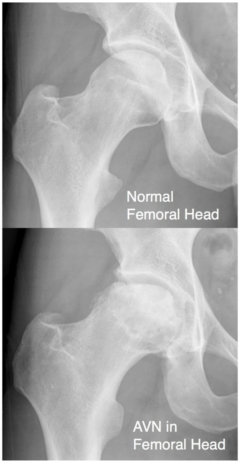 Hip_Avascular_Necrosis.jpeg