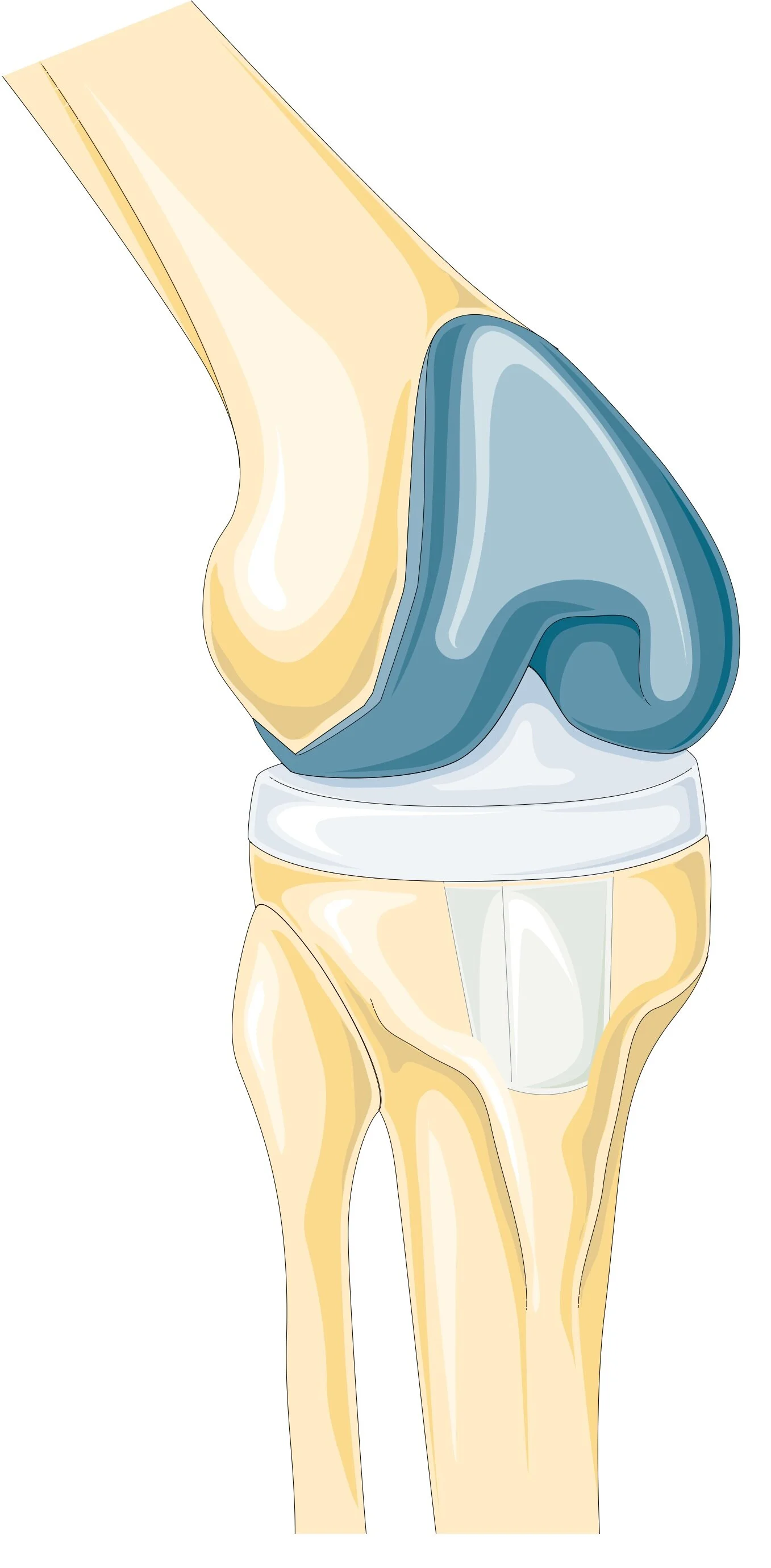 https://commons.wikimedia.org/wiki/SMART-Servier_Medical_Art#/media/File:Thigh_bone_fracture_-_Fracture_of_femur_--_Smart-Servier.jpg