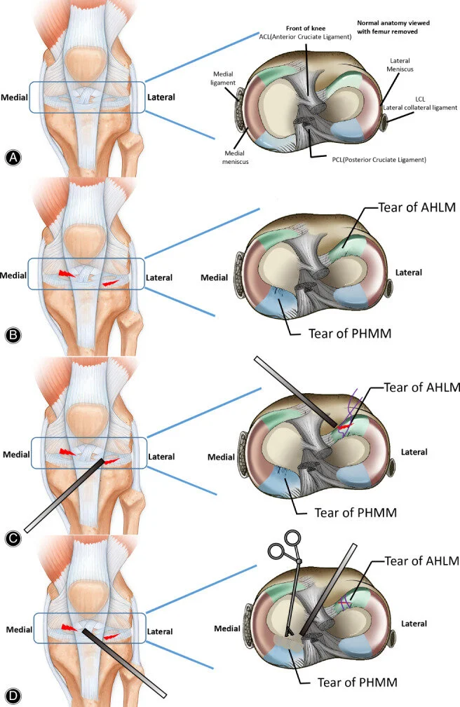 Jun‐cheng Cui, Wen‐te Wu, Long Xin, Zhi‐wei Chen, Peng‐fei Lei (2021). Efficacy of Arthroscopic Treatment for Concurrent Medial Meniscus Posterior Horn and Lateral Meniscus Anterior Horn Injury: A Retrospective Single Center Study. Orthopaedic Surgery. SAGE Open. doi: 10.1111/os.12820