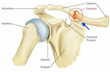 Medina Perez G, Tran MM, McDonald C, O'Donnell R, Cruz AI Jr. Factors Affecting Patient Decision-Making Regarding Midshaft Clavicle Fracture Treatment.&nbsp;Cureus. 2020;12(9):e10505. Published 2020 Sep 17. doi:10.7759/cureus.10505