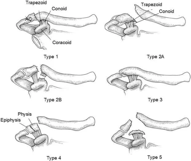 Blaas LS, van Sterkenburg MN, de Planque AM, Derksen RJ. New possibilities: the LockDown device for distal clavicle fractures. JSES Int. 2020 Oct 15;4(4):713-718. doi: 10.1016/j.jseint.2020.08.021. PMID: 33345204; PMCID: PMC7738585.