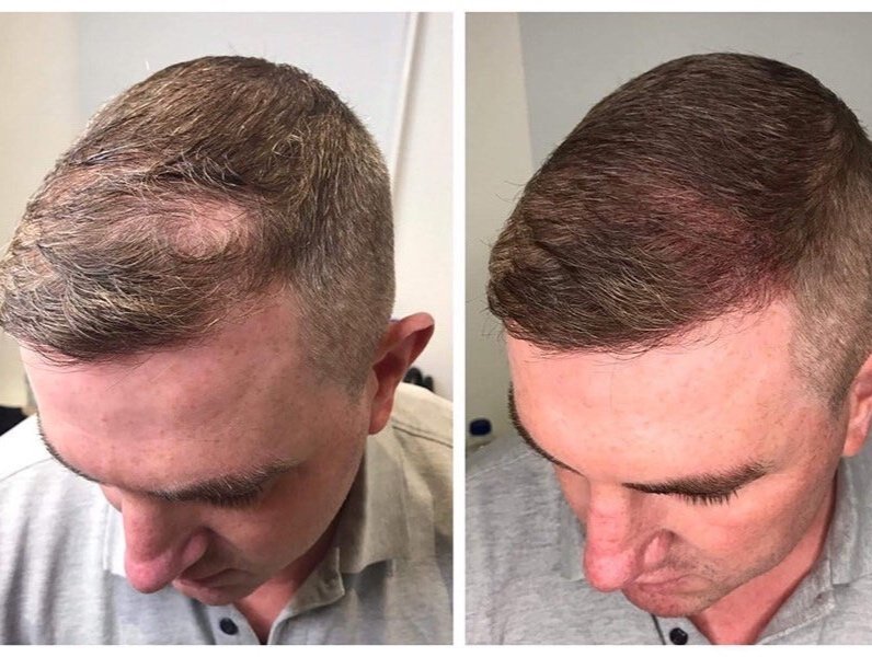 Scalp Micropigmentation