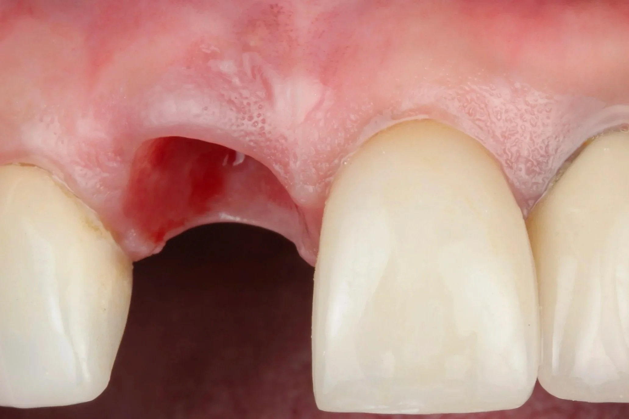 Preservation - the Partial Extraction Therapy Masterclass 2026