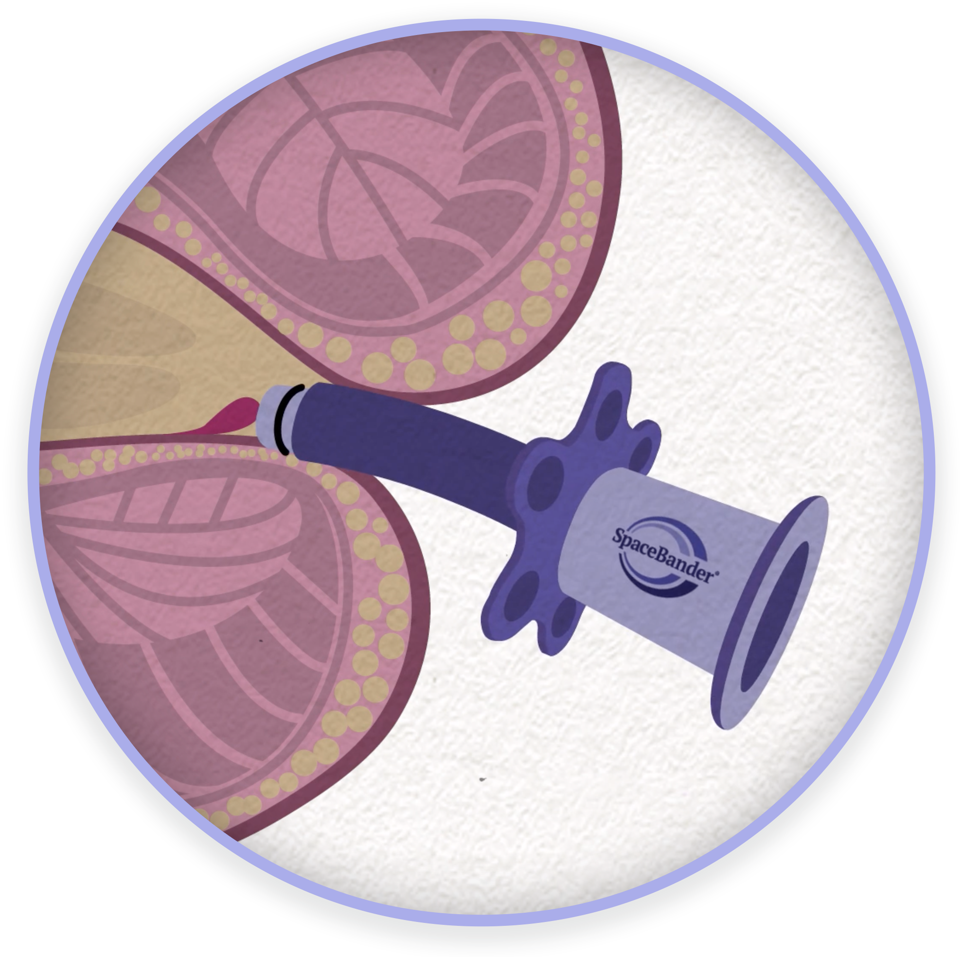 It is a simple procedure where a rubber band is deployed at the base of an internal hemorrhoid