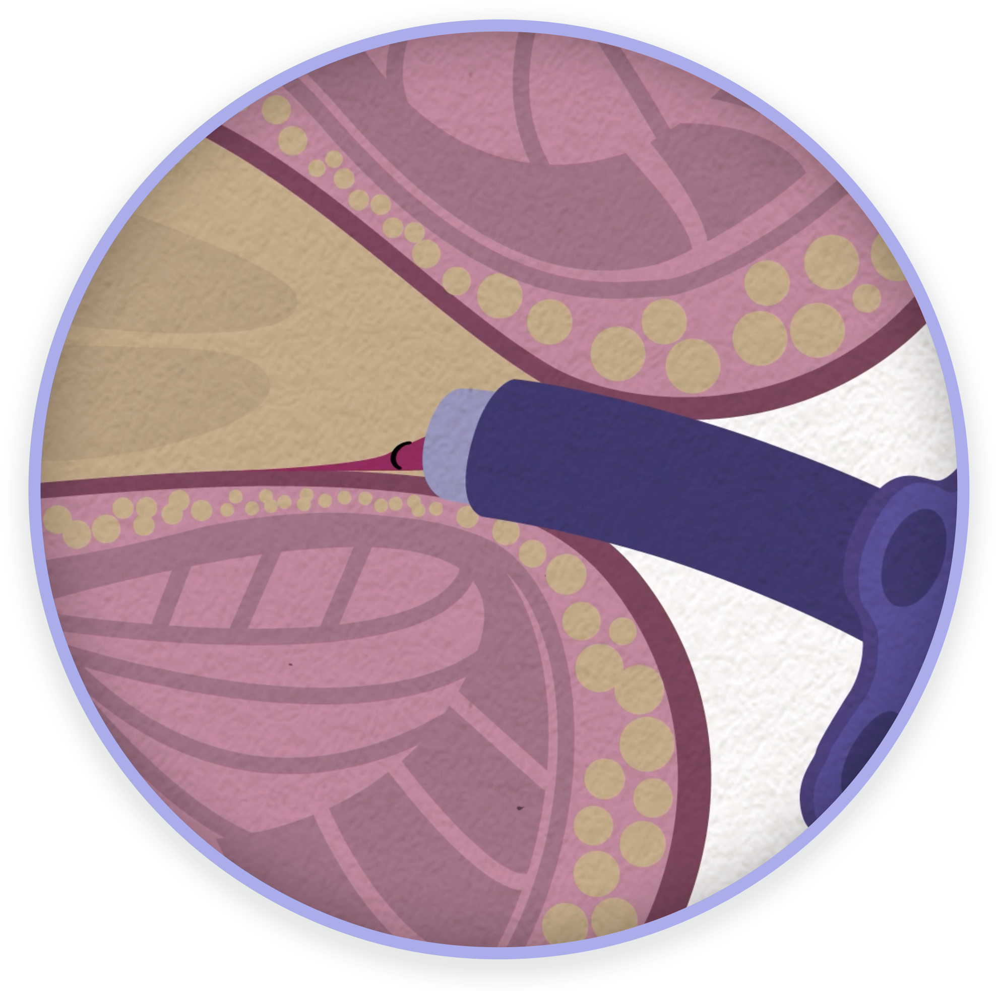 As the blood supply to the hemorrhoid is reduced, shrinkage and degeneration occur