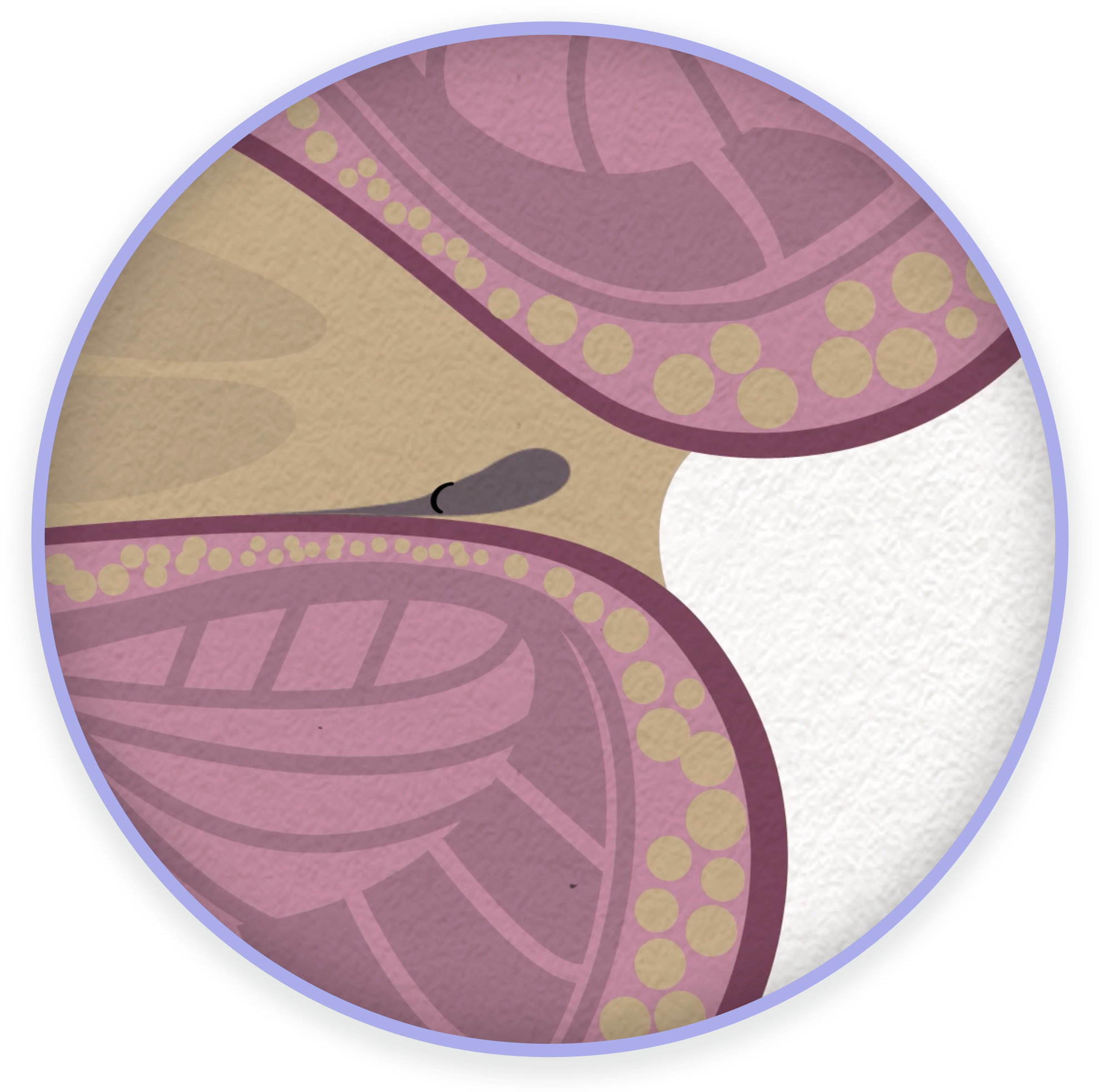 After a few days, the hemorrhoid and the rubber band fall off and the patient heals naturally