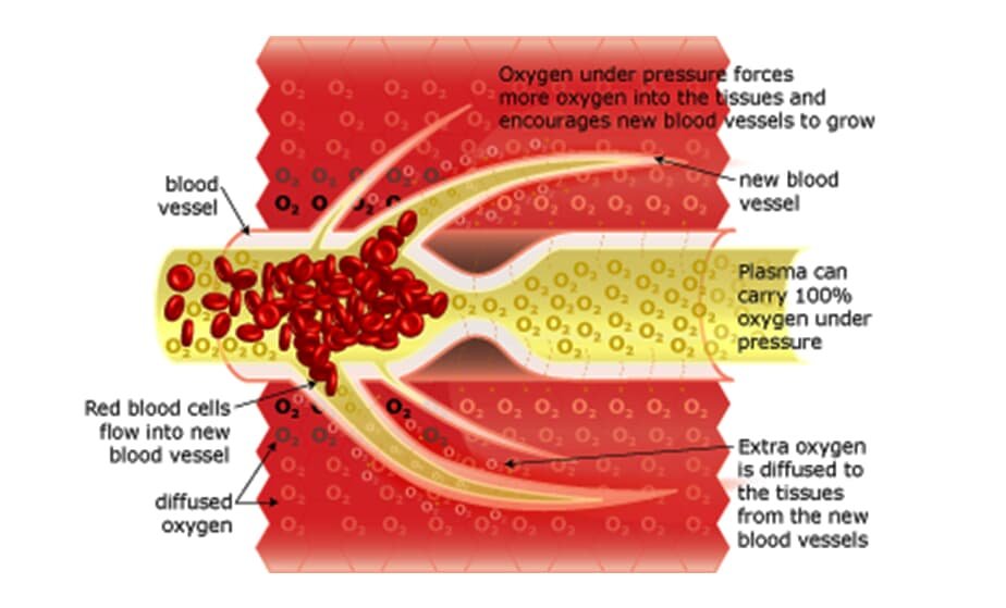 Hyperbaric blood vessel3.jpg