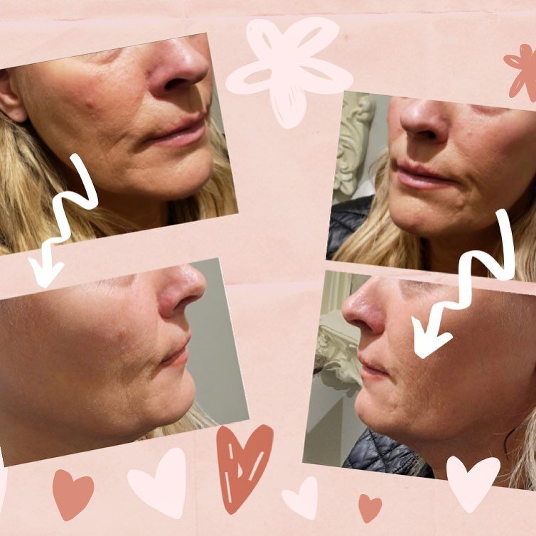 Want UPLIFTING, Natural-Looking Results? 

RADIESSE  is a dermal filler that works to lift and define and also smooth moderate to severe facial wrinkles and folds.

Before and After Pics -Radiesse was injected in client&rsquo;s cheeks, naslabial fold