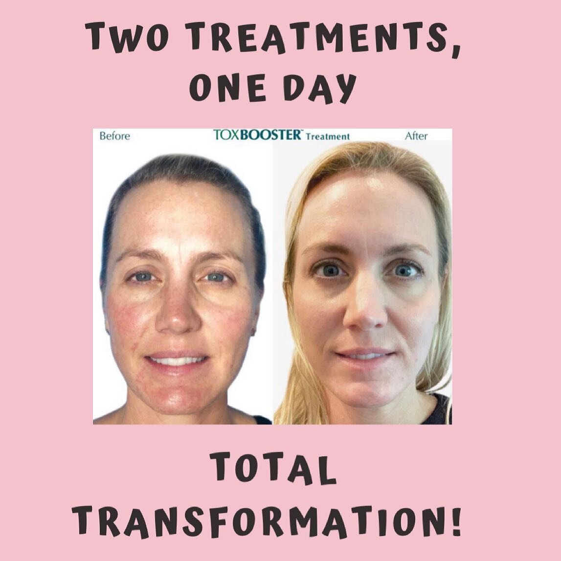 Two Treatments, One Appointment, Long Lasting Results! 

Come On In for a VI Peel and TOX Booster Injection Treatment! 

 VI Peels treat acne, melasma, aging, hyperpigmentation and scarring, while increasing cell turnover and stimulating collagen pro