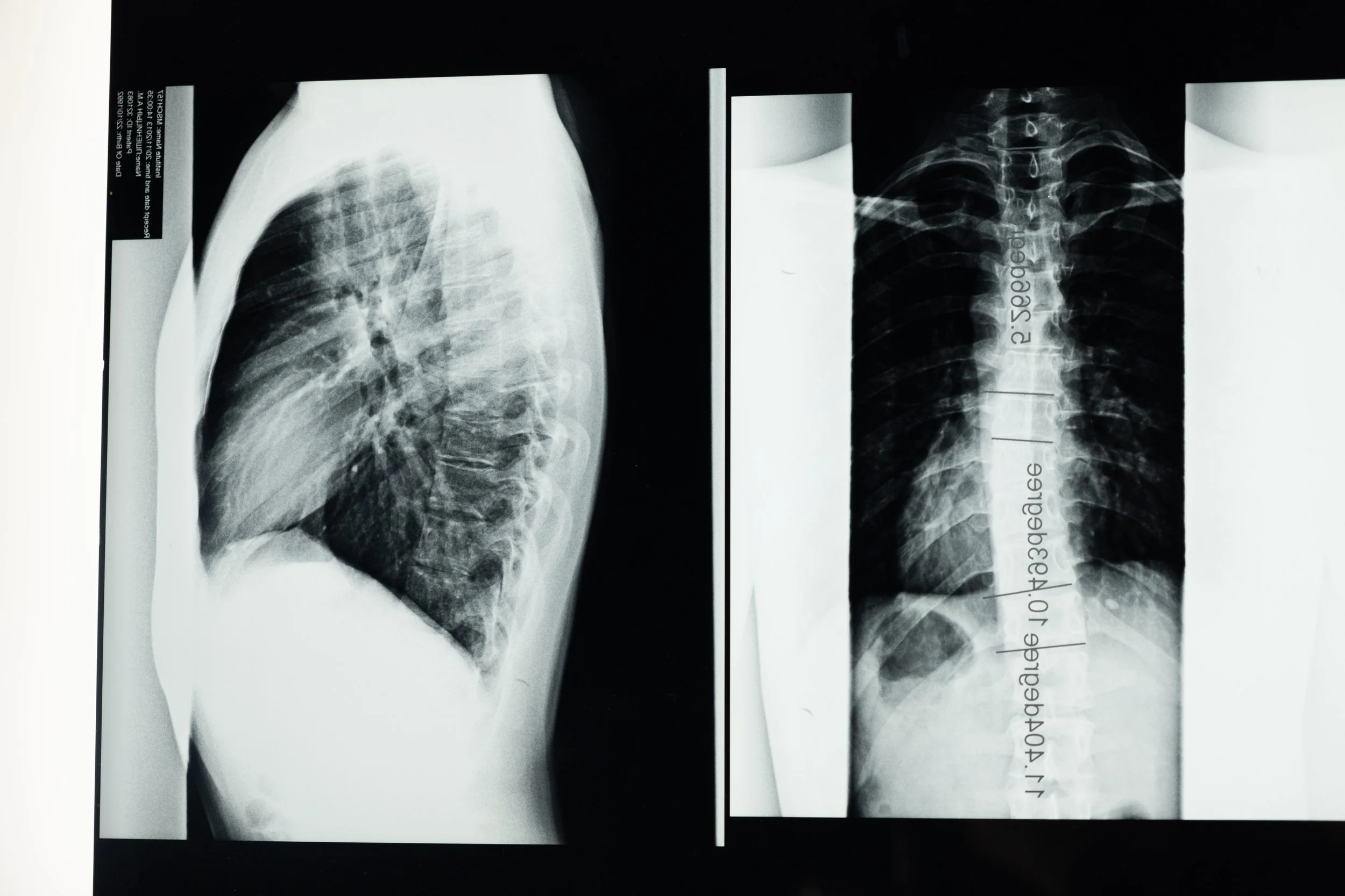 Ann Arbor Chiropractors and Ypsilanti Chiropractors Offer Palliative Care for Scoliosis