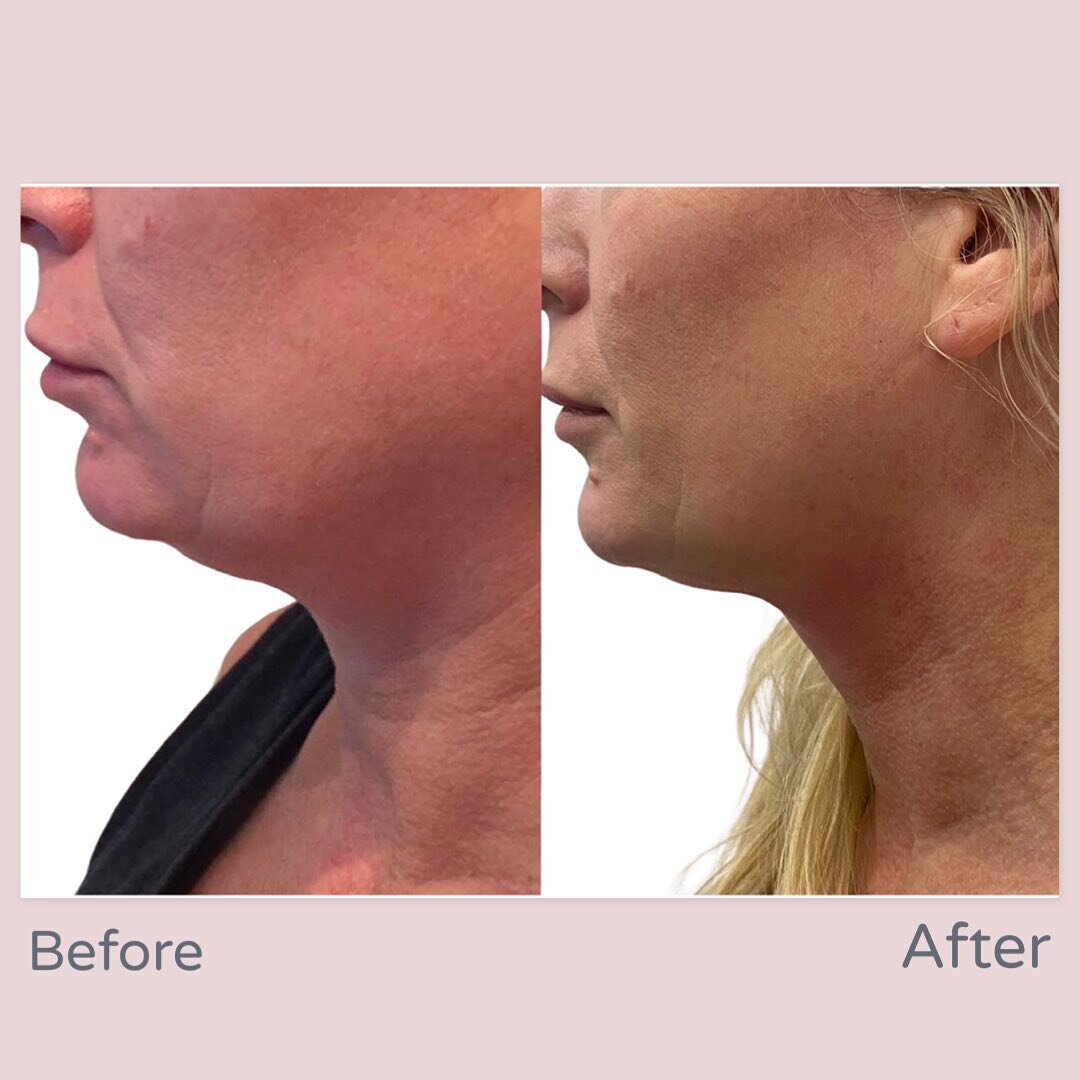 The Chin Sculpt.. Results of our gorgeous client after just 1 session of fat freezing to target the &ldquo;double chin&rdquo;..
No downtime, no bruising, no needles!! DM for a free consult or any questions you may have.. We can&rsquo;t wait to see yo